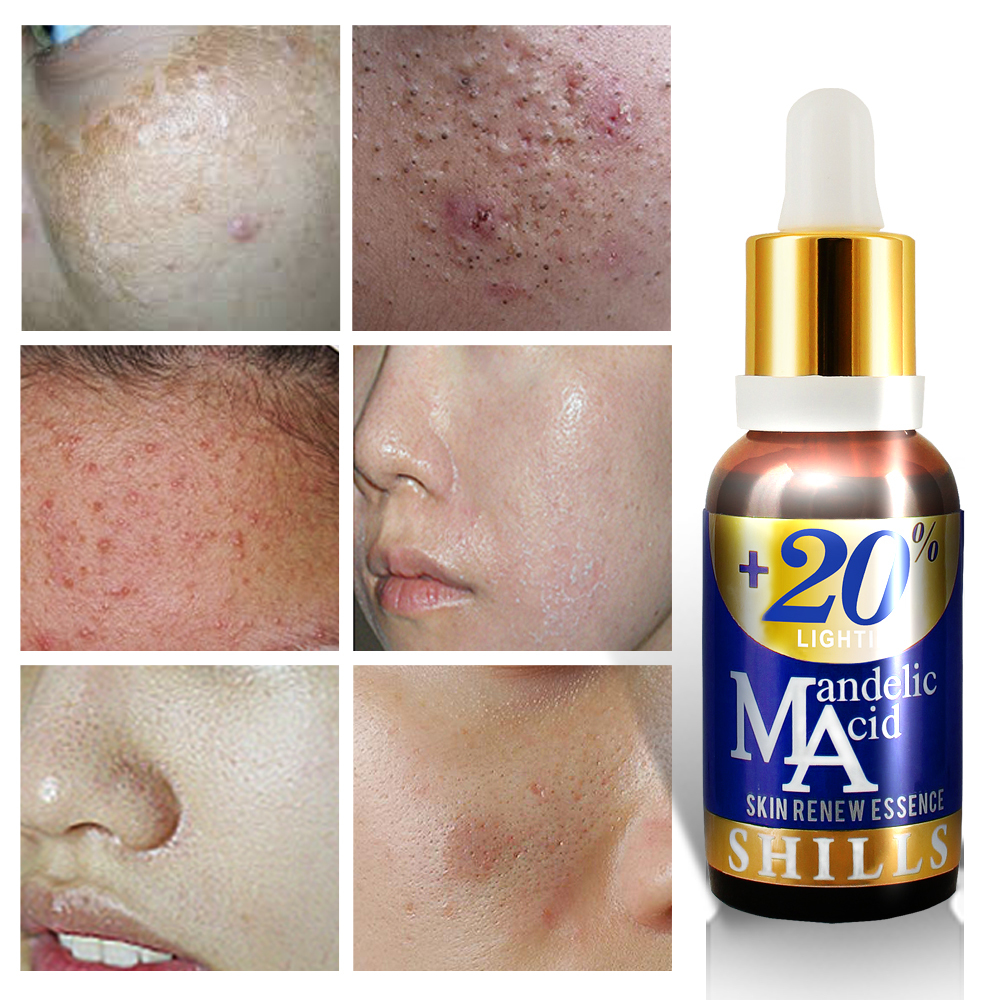 SHILLS Mandelic Acid & Vitamin E Anti Acne & Scars Face