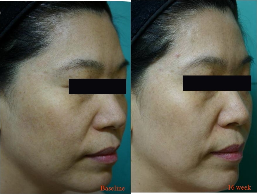 左旋C增生膠原蛋白