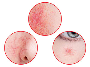 淨化肌膚泛紅,紅血絲,蜘蛛網狀擴張,特有抗紅成分讓肌膚恢復靚白,彈性與光澤