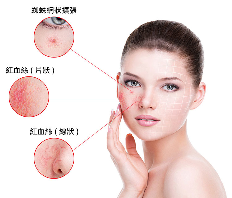 妳吹彈可破的臉頰容易變成紅通通的蘋果臉嗎？日曬,風吹,天氣變化就泛紅,吃辣,飲酒,運動也漲紅了臉,去美容護膚時不能用雷射,果酸,或是已經在鼻子,臉頰及下巴出現紅血絲或蜘蛛網狀擴張