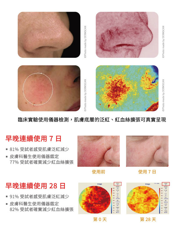 經皮膚科醫生以專業儀器檢測 RBC 濃度,早晚使用抗紅修護精華二十八日後,數值由 345A.U 降低至 287A.U 高達 82% 確實淨化肌膚,且 91% 受試者感到肌膚泛紅減少
