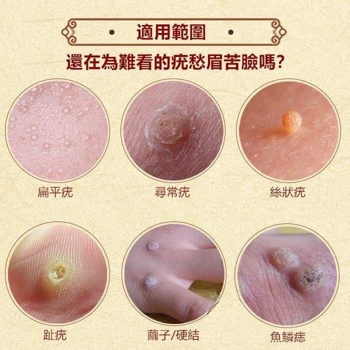 日本🇯🇵 Y389去疣神膏