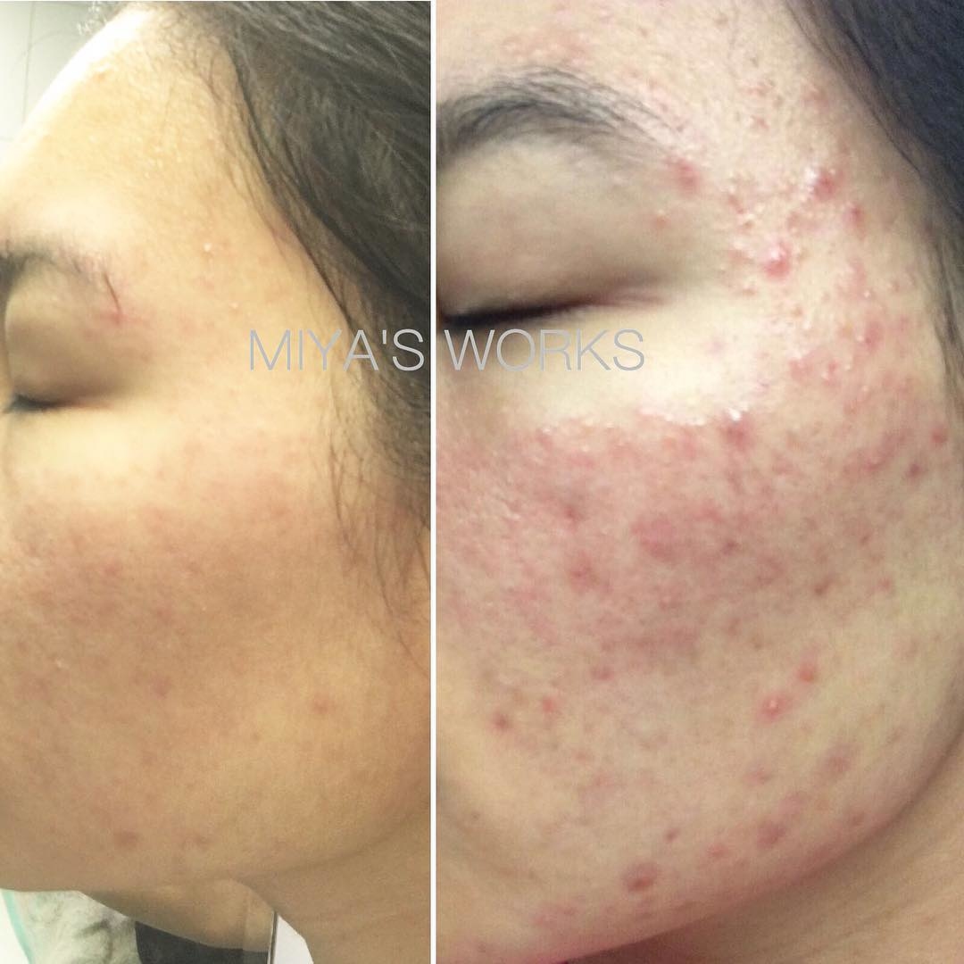 面部暗瘡問題改善前後圖