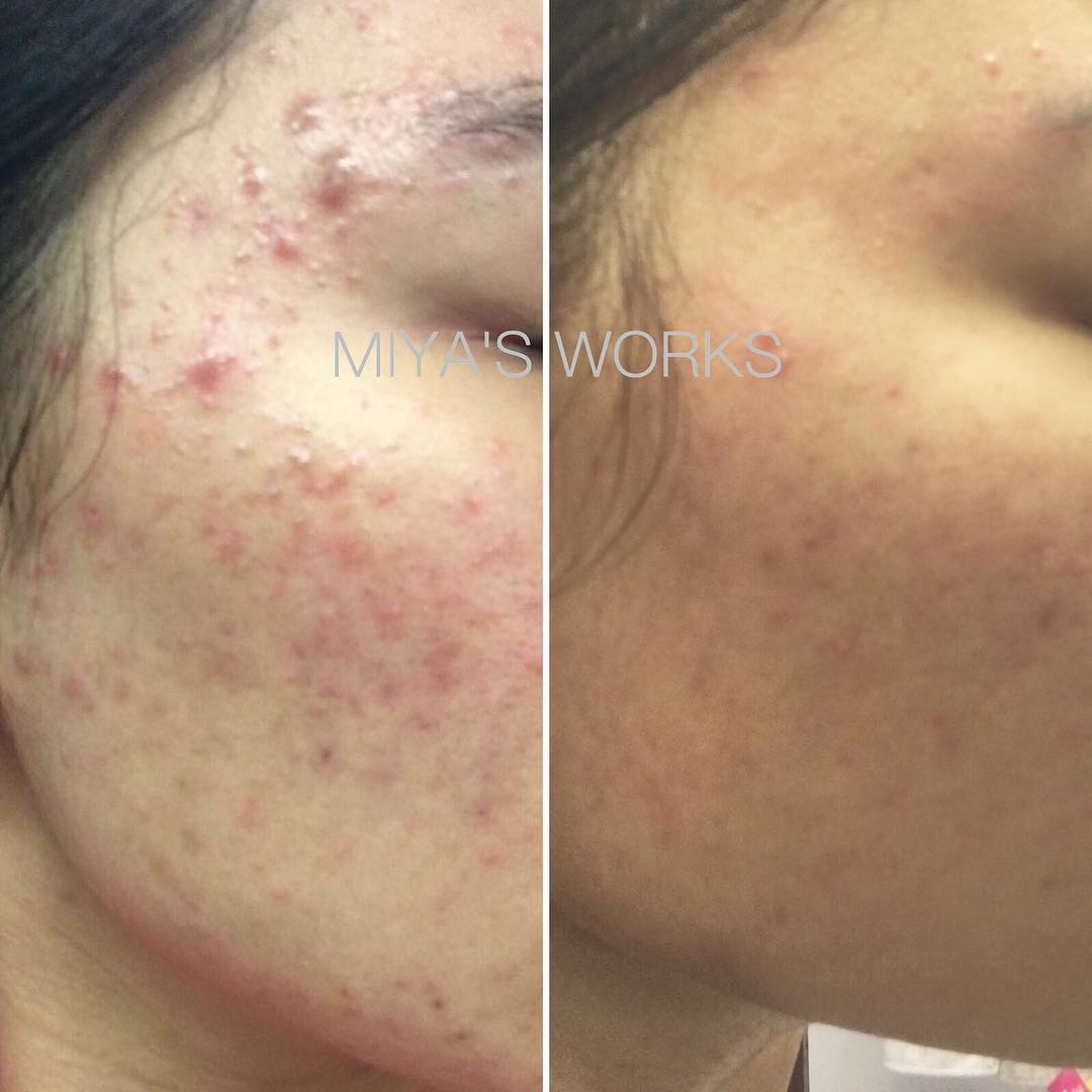 面部暗瘡問題改善前後圖
