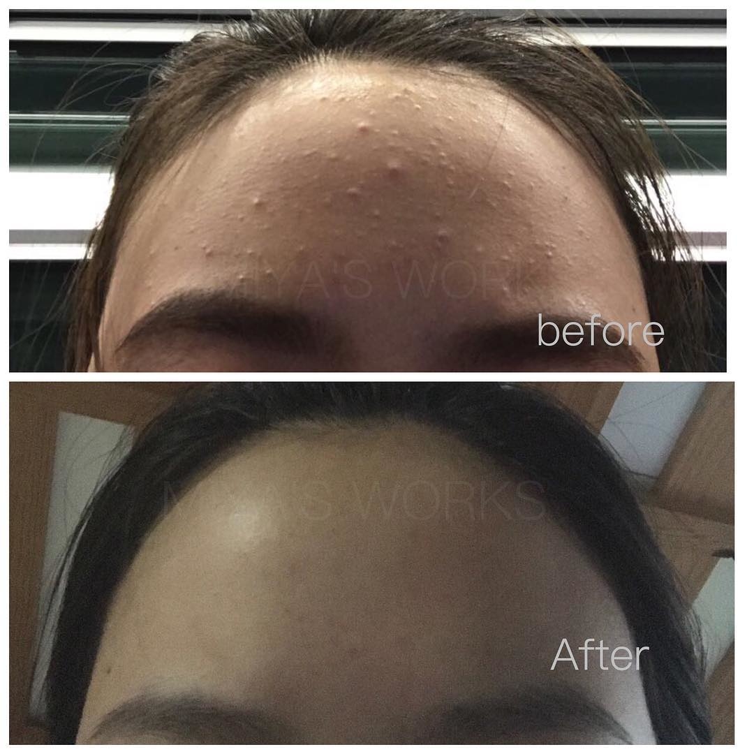 額頭暗粒問題改善前後圖