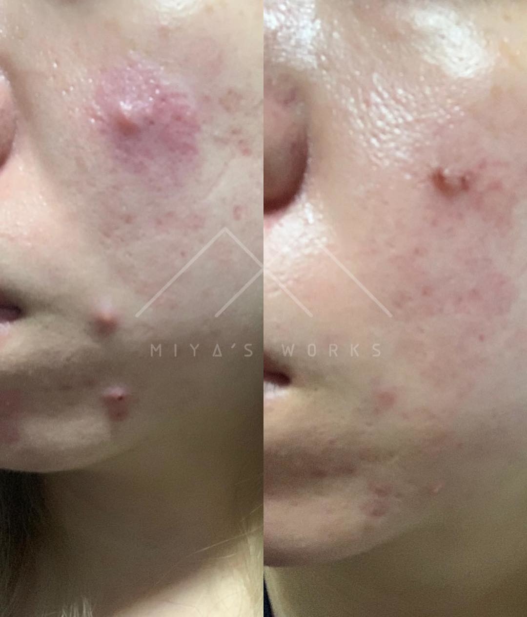 面部暗瘡問題改善前後圖