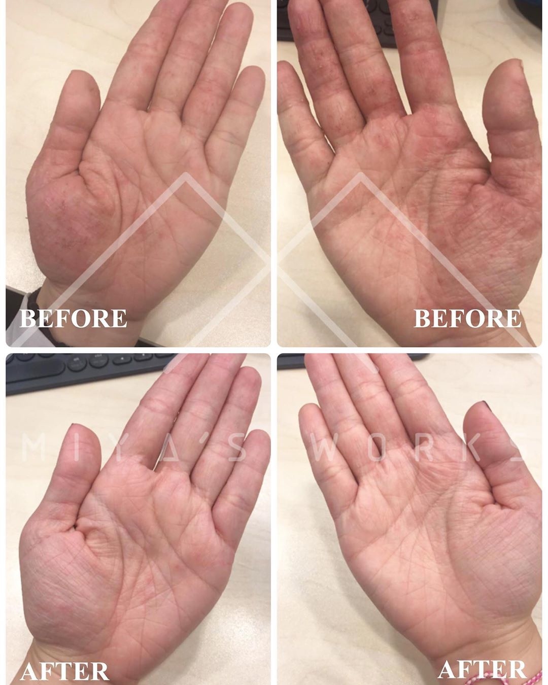 手掌濕疹問題改善前後圖