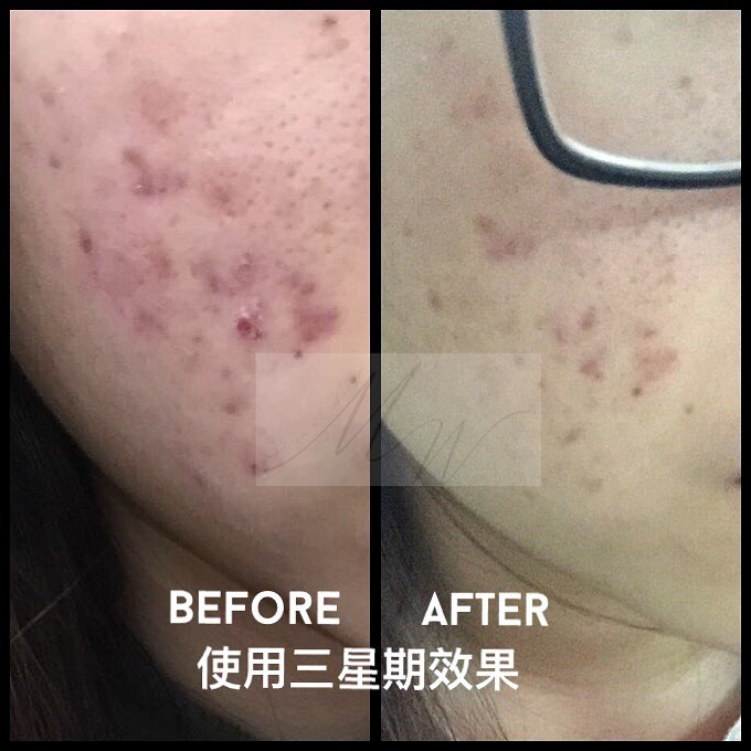 面部暗瘡問題改善前後圖