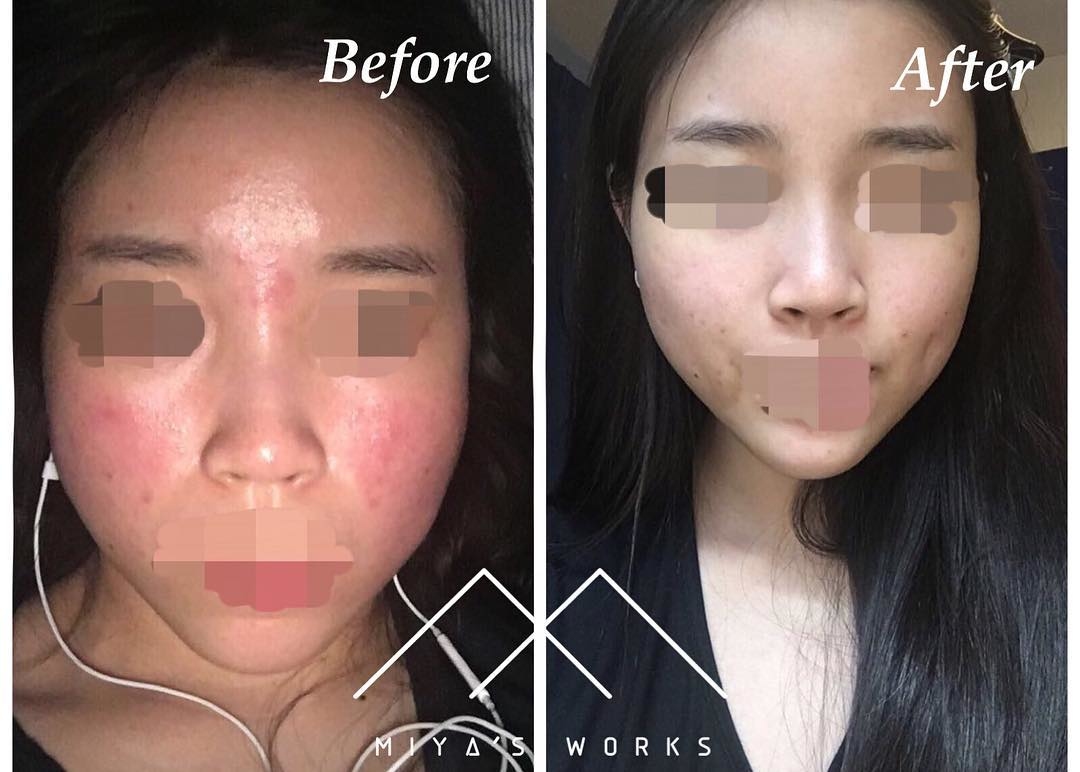 面部暗瘡問題改善前後圖