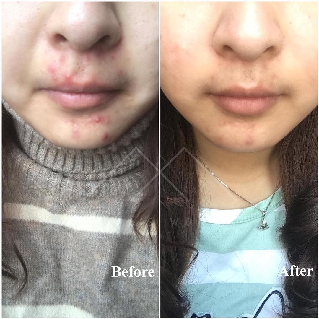 面部暗瘡問題改善前後圖