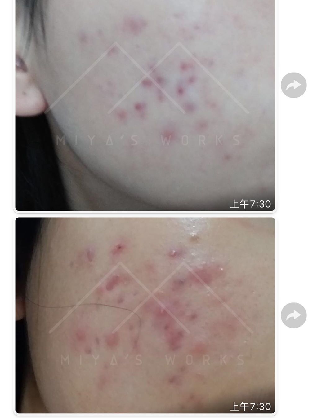 面部暗瘡問題改善前後圖