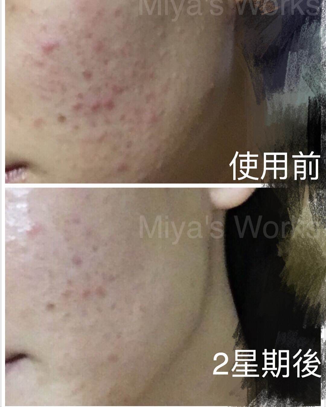 面部暗瘡問題改善前後圖