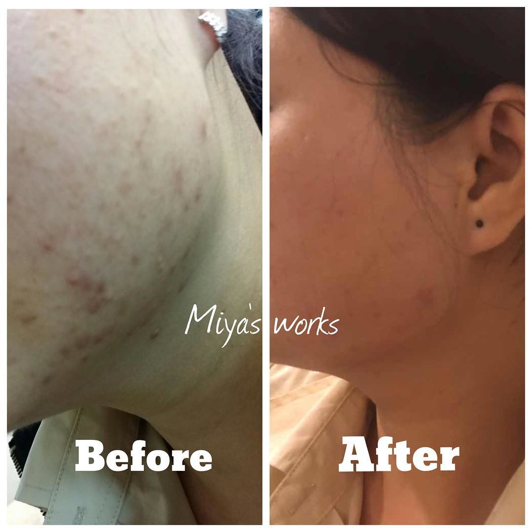 面部暗瘡問題改善前後圖