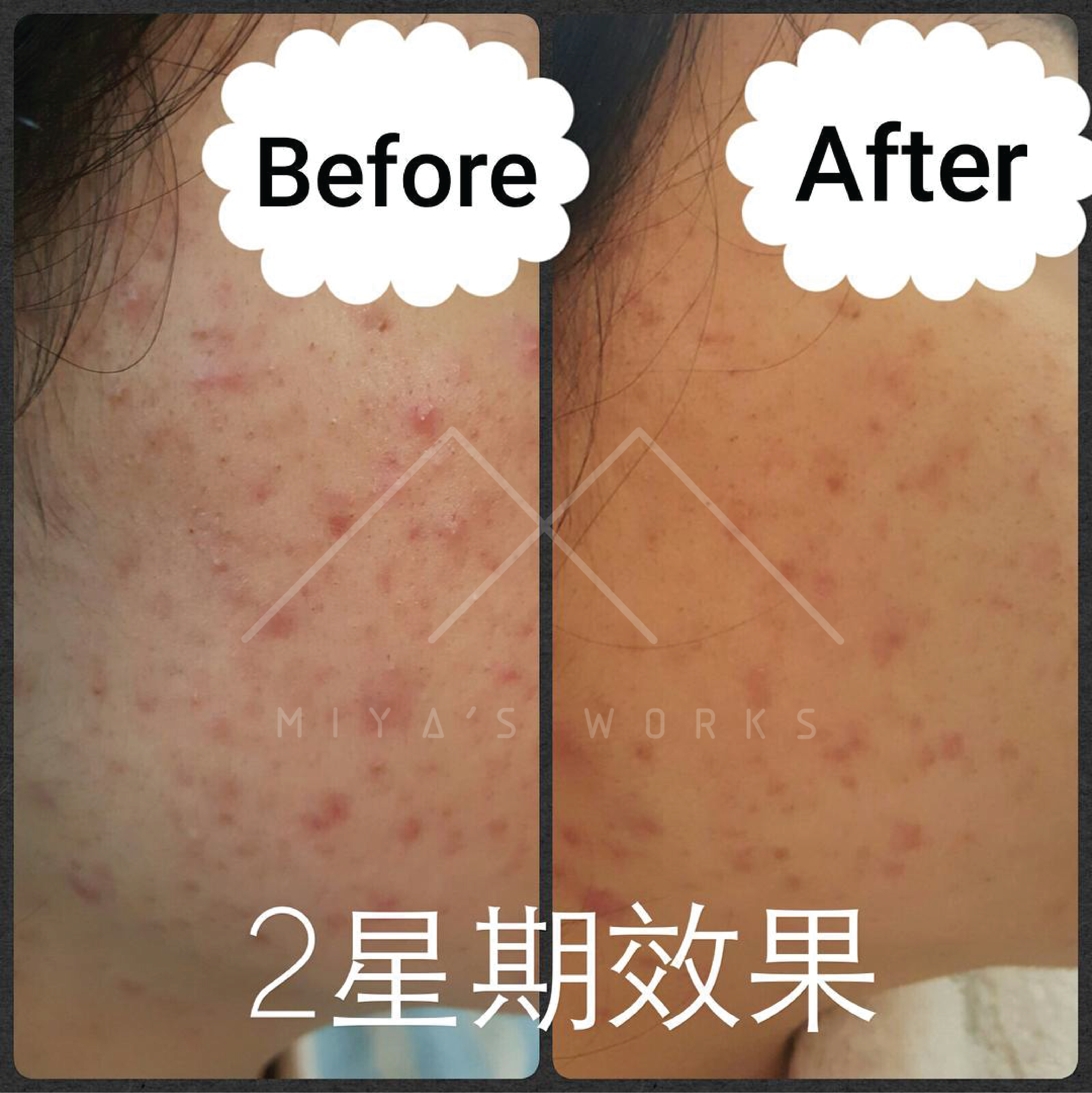 面部暗瘡問題改善前後圖