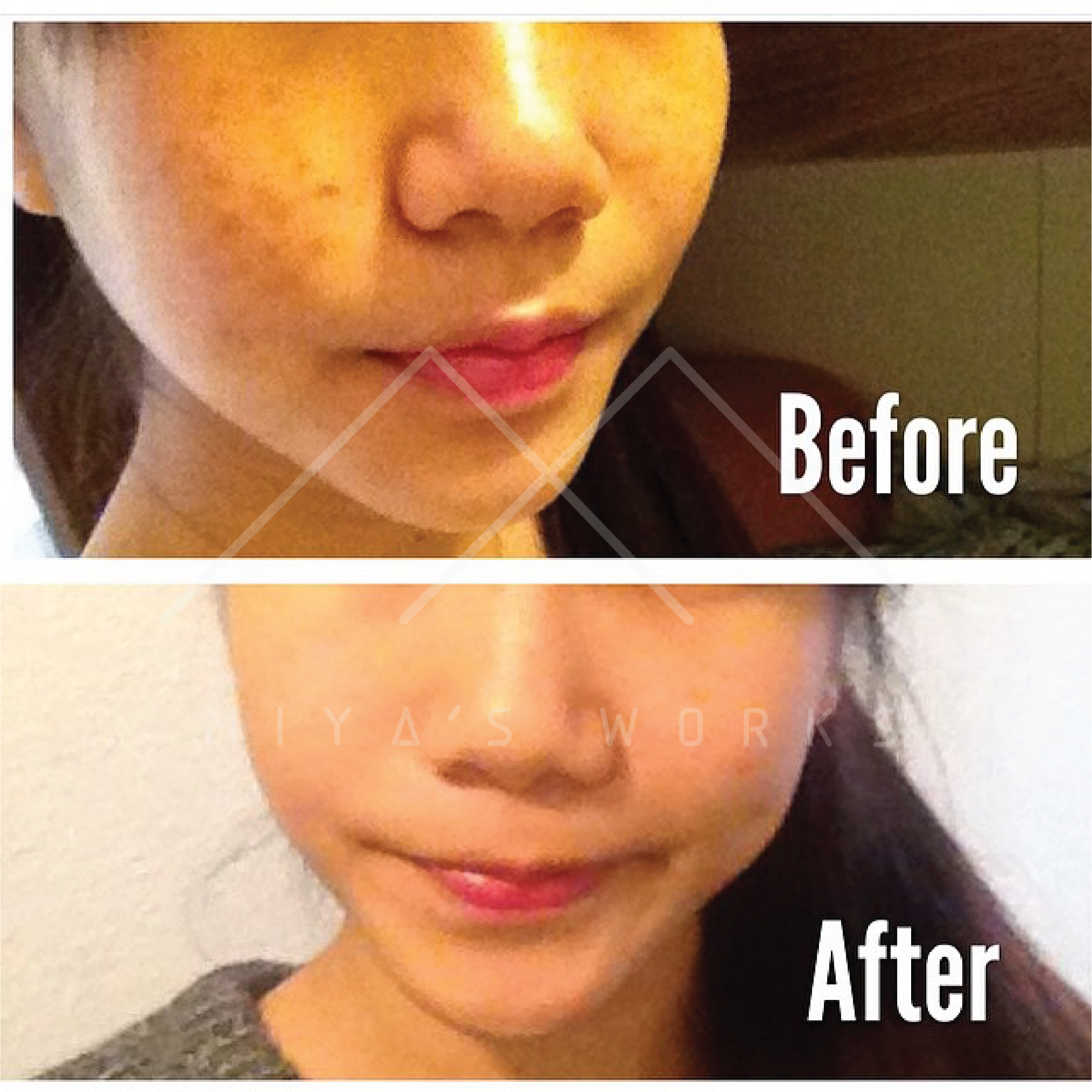 面部暗瘡問題改善前後圖