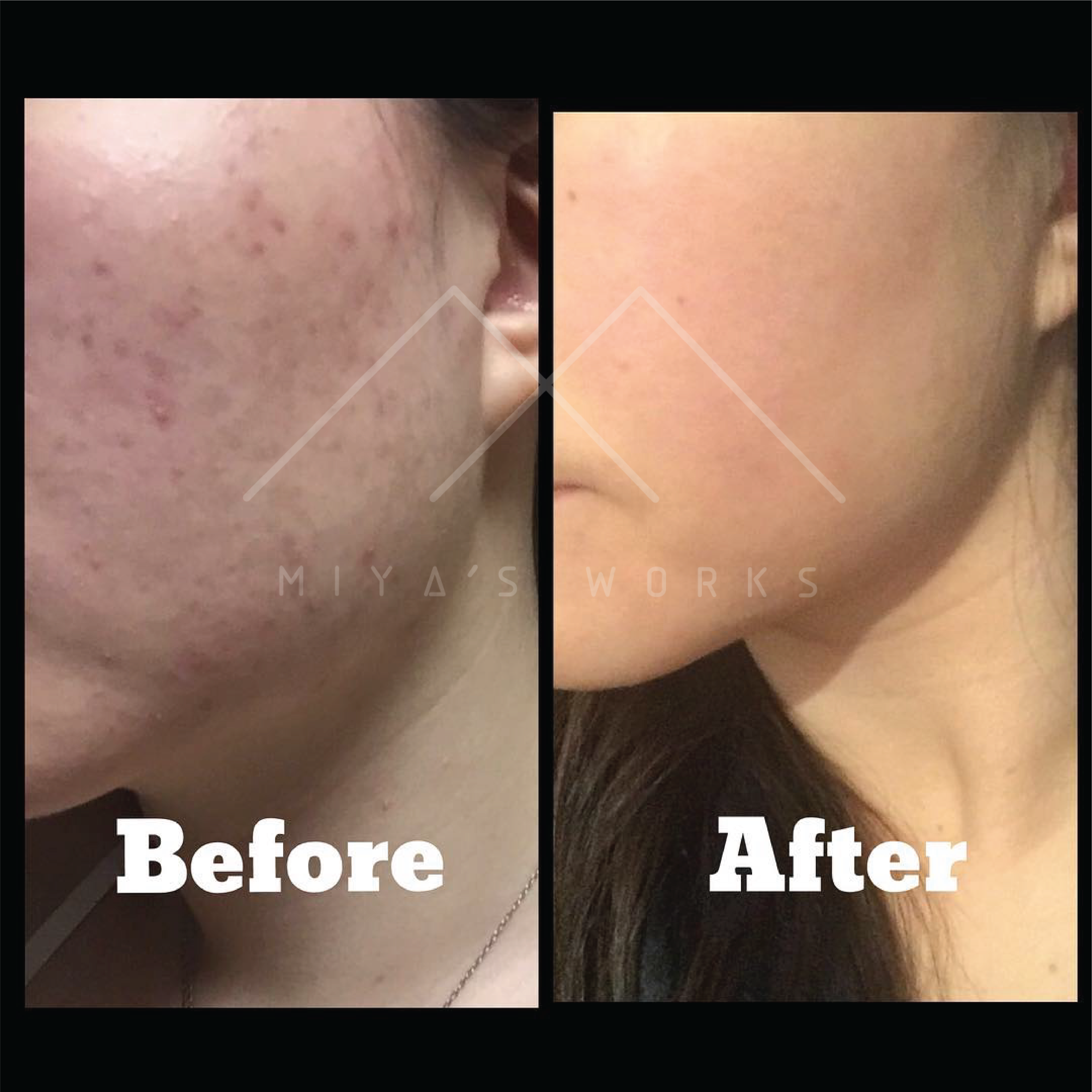 面部暗瘡問題改善前後圖