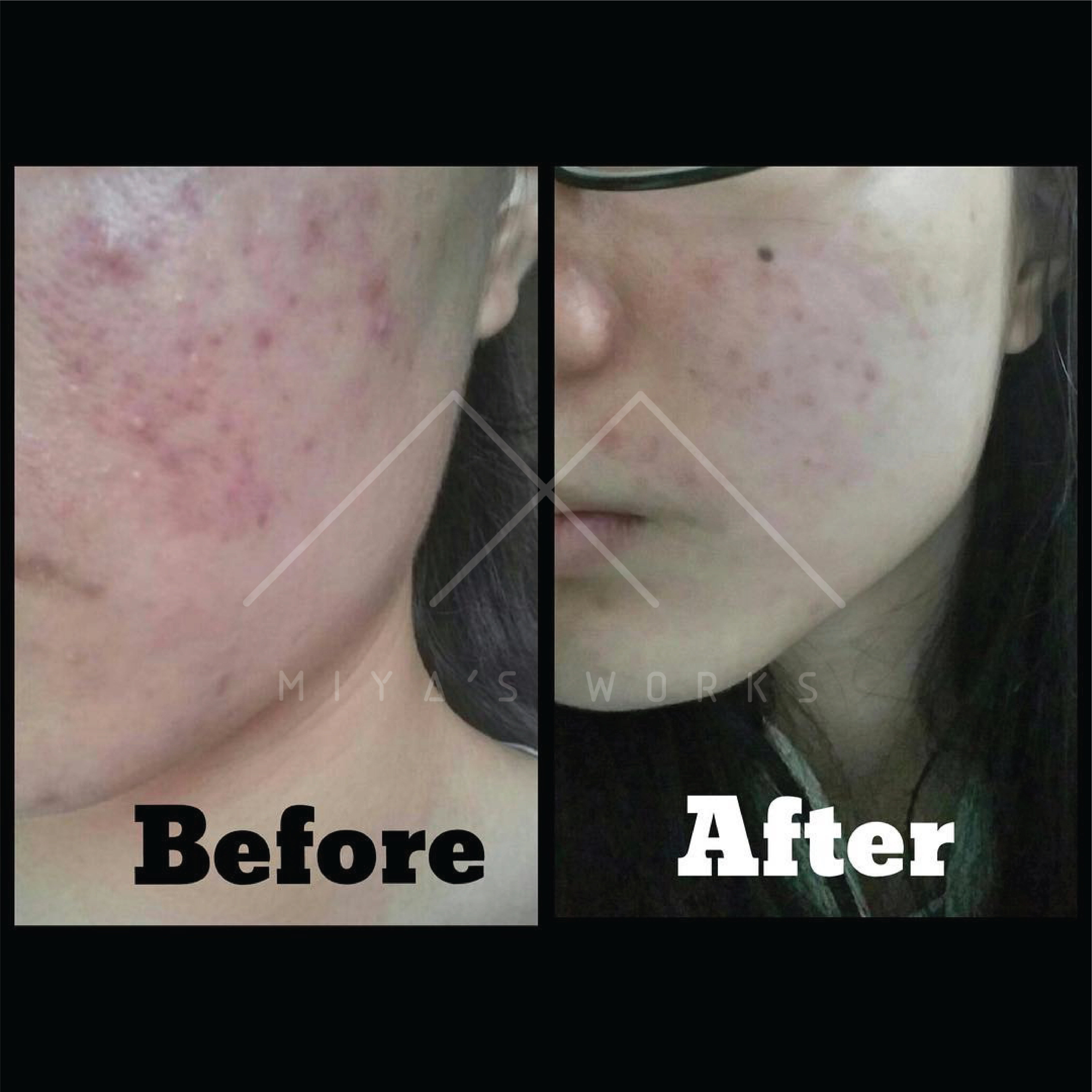 面部暗瘡問題改善前後圖