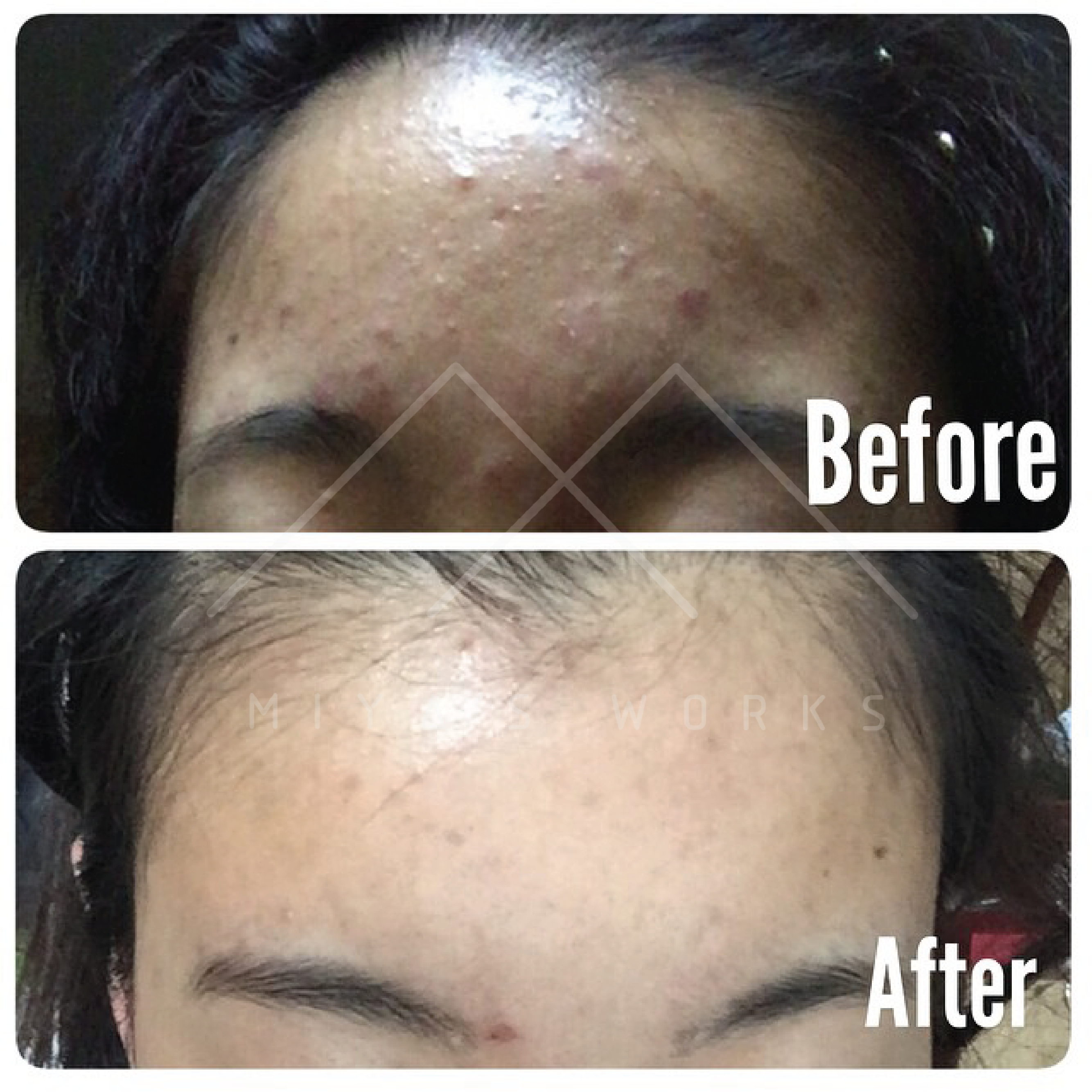 額頭暗瘡問題改善前後圖