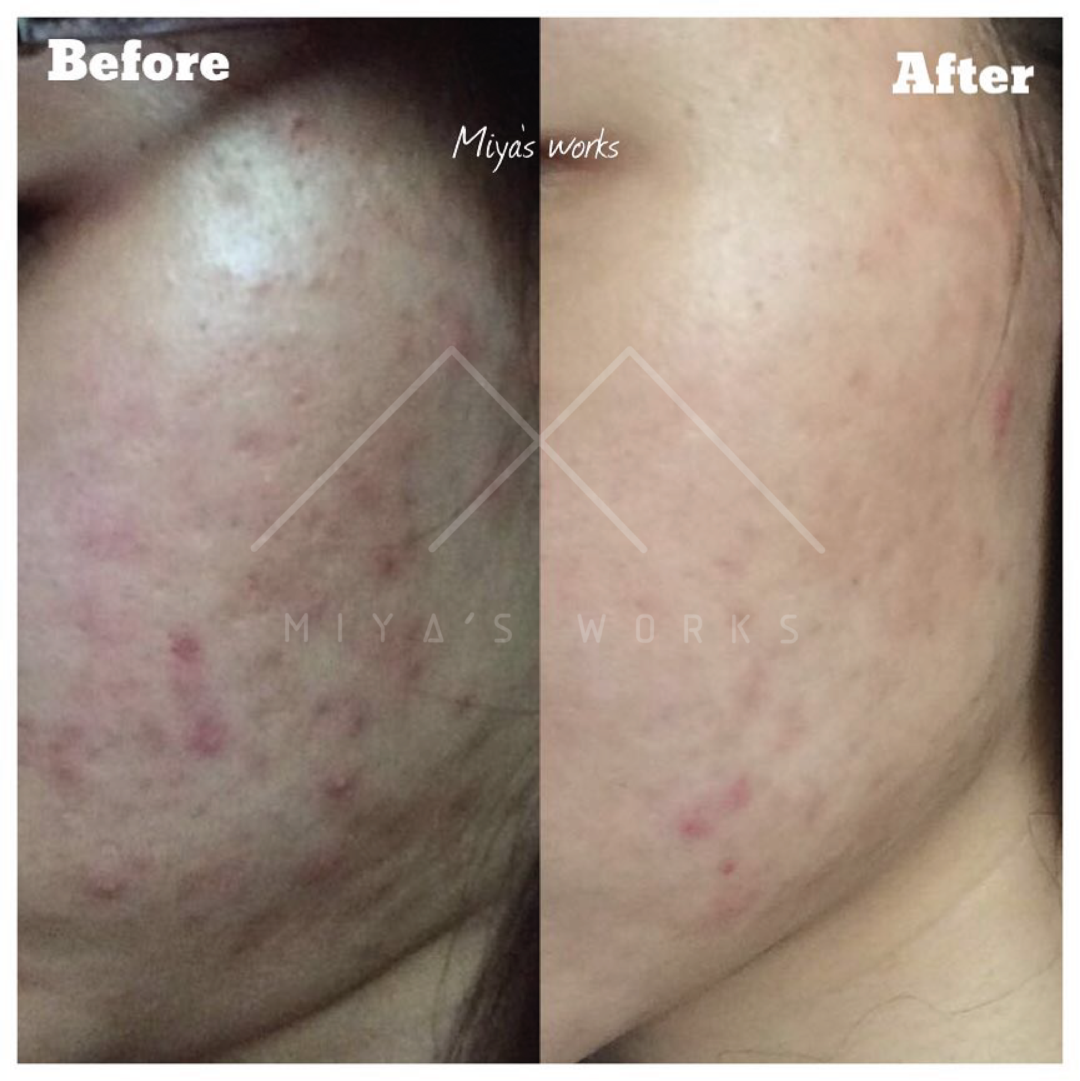 面部暗瘡問題改善前後圖
