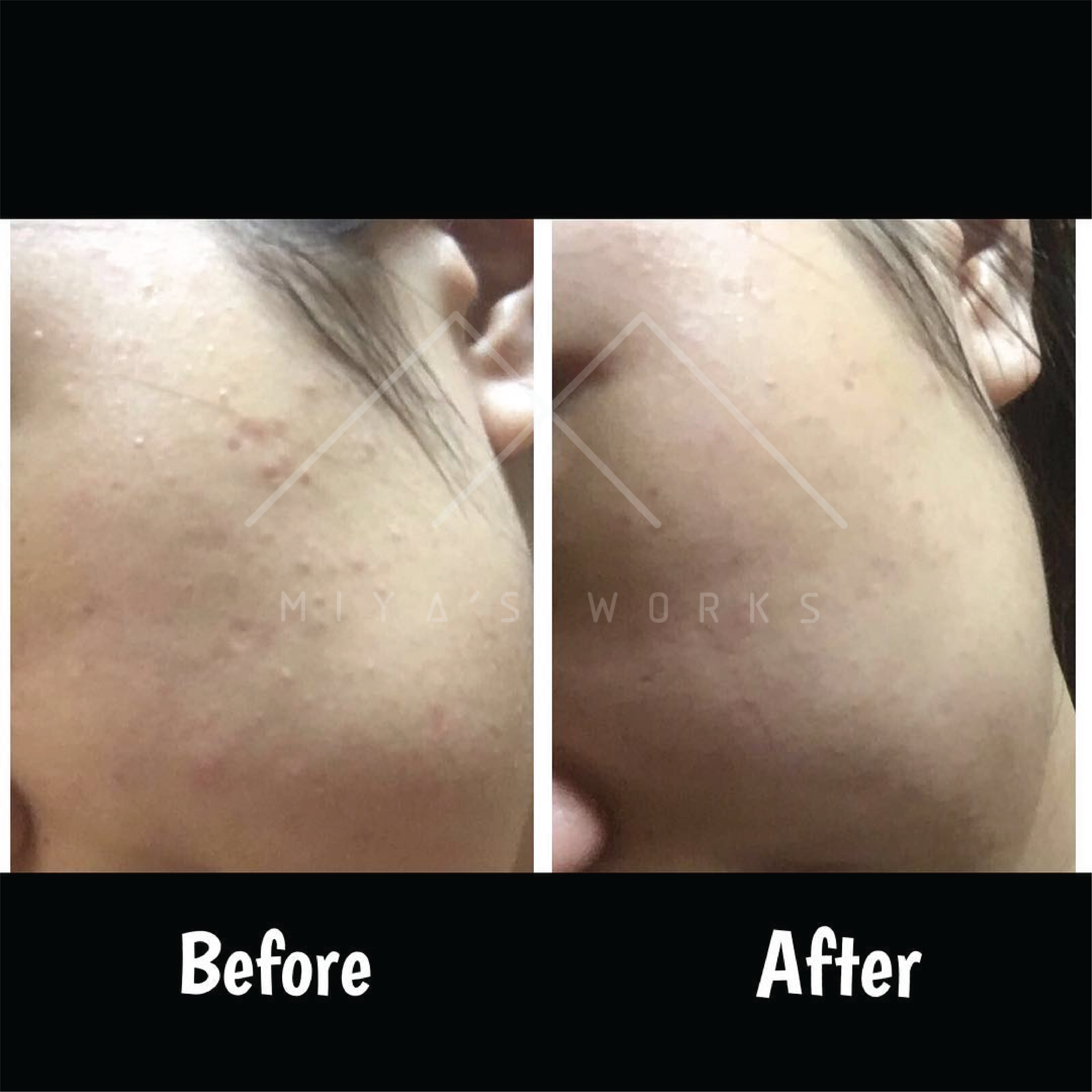 面部暗瘡問題改善前後圖