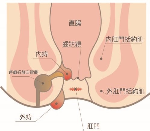 說不出口的隱疾 痔瘡