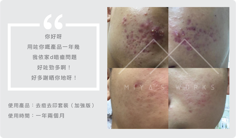 使用去痘去印套裝加強版一年多成功改善暗瘡問題