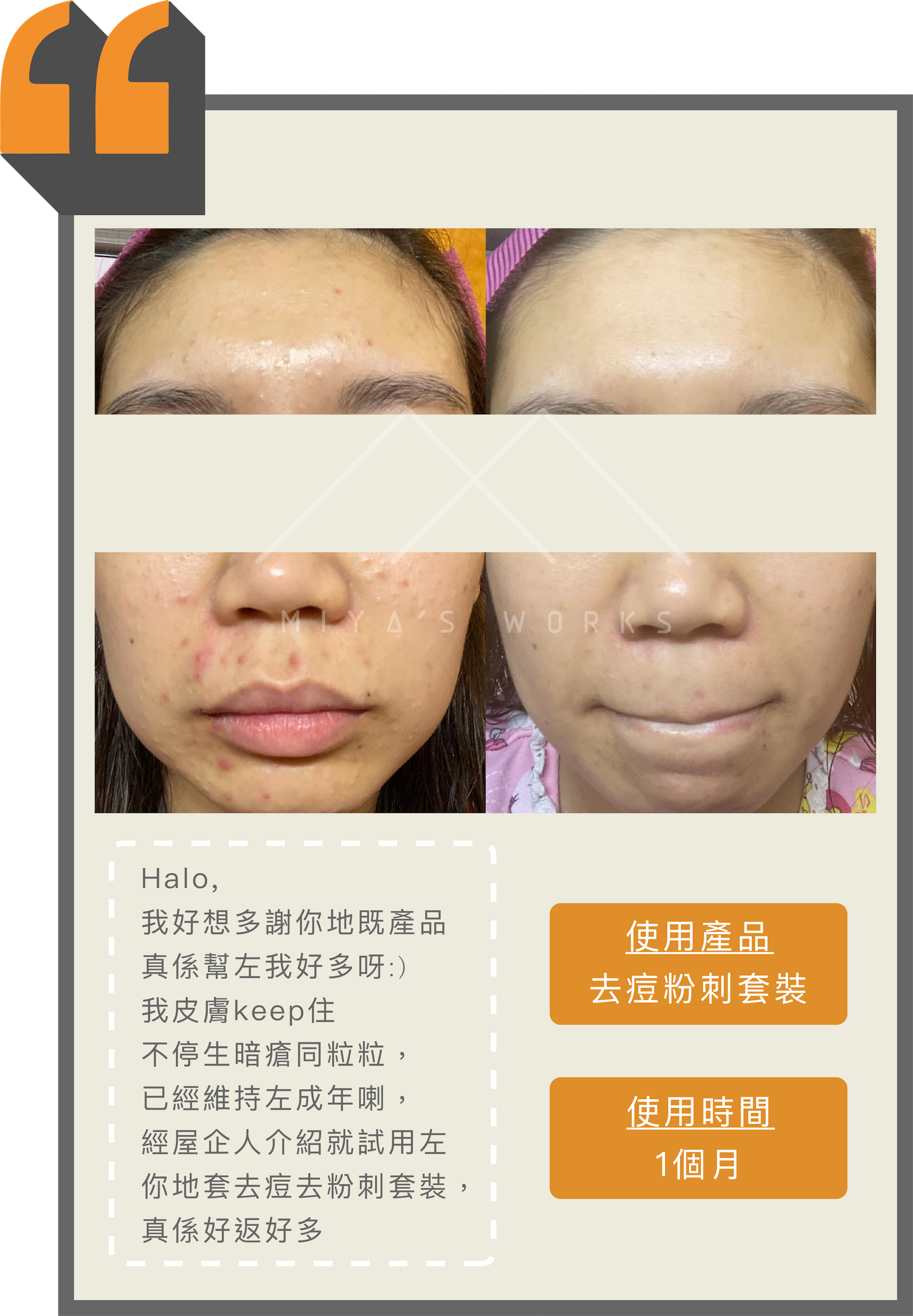 不停生暗瘡及粒粒使用去痘粉刺套裝皮膚好轉