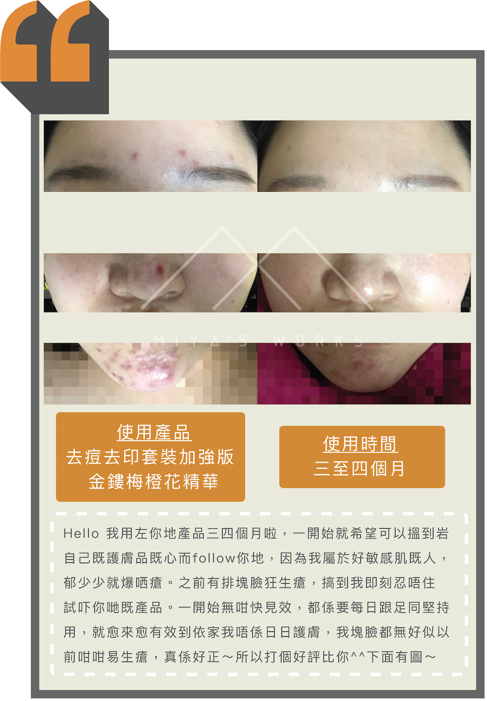 敏感肌使用去痘去印套裝加強版及金縷梅橙花精華成功改善皮膚少生瘡