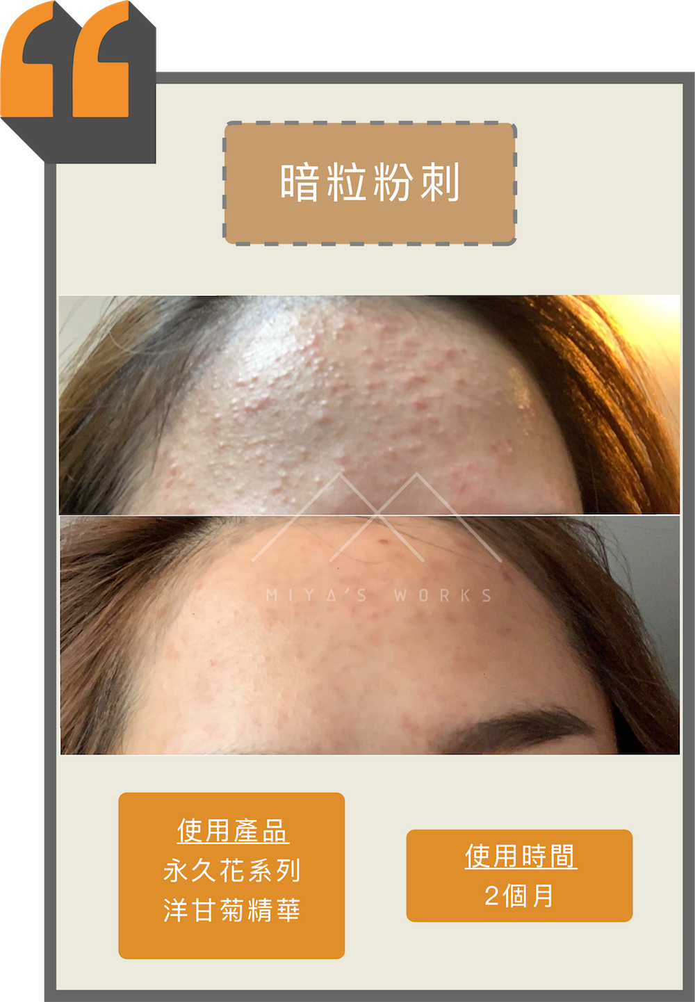 使用永久花系列及洋甘菊精華改善額頭暗粒粉刺