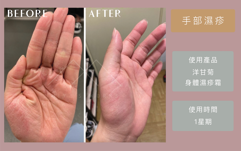 使用洋甘菊身體濕疹霜改善手部濕疹情況