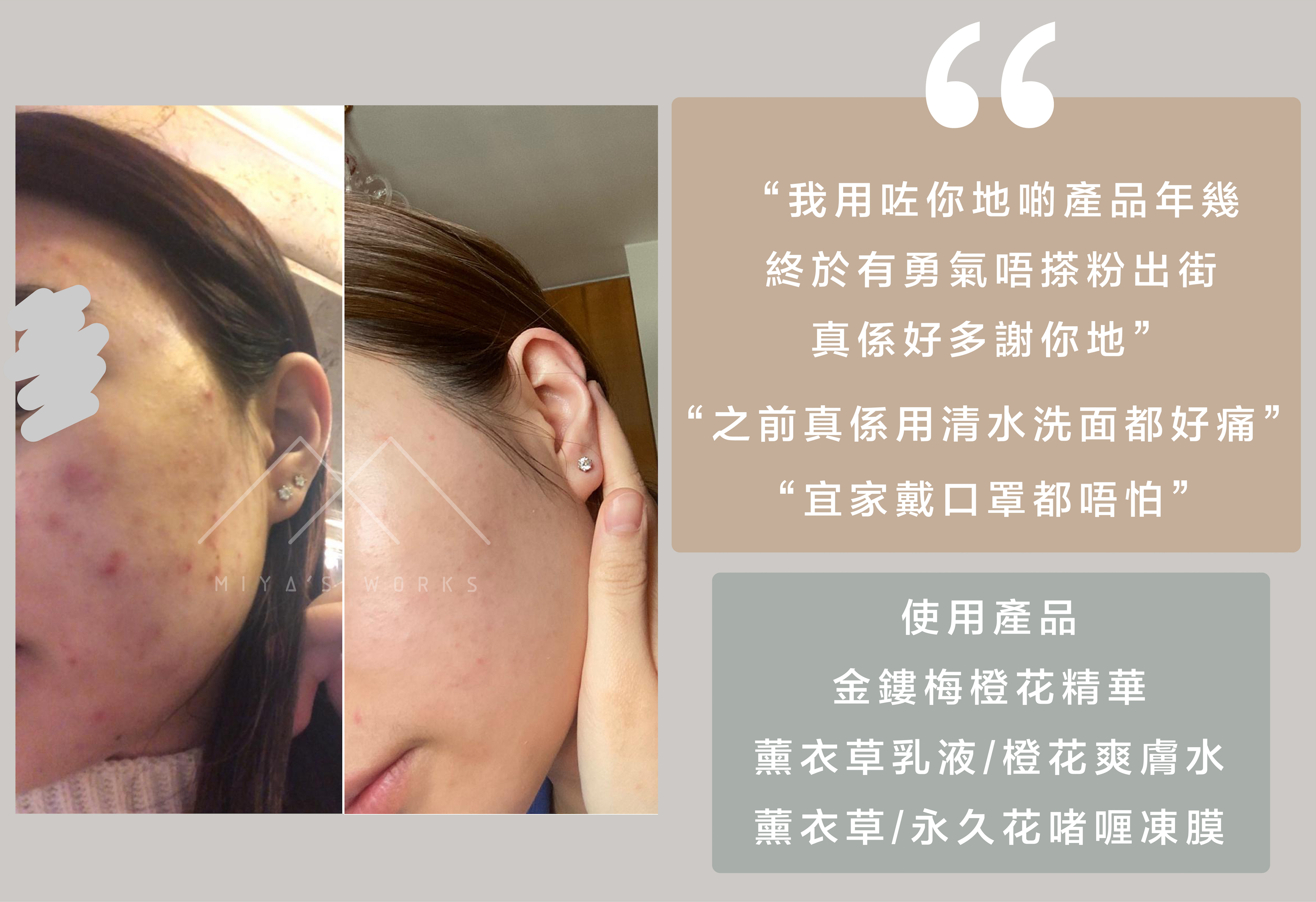 使用金縷梅橙花精華薰衣草乳液永久花凍膜消退暗瘡暗粒