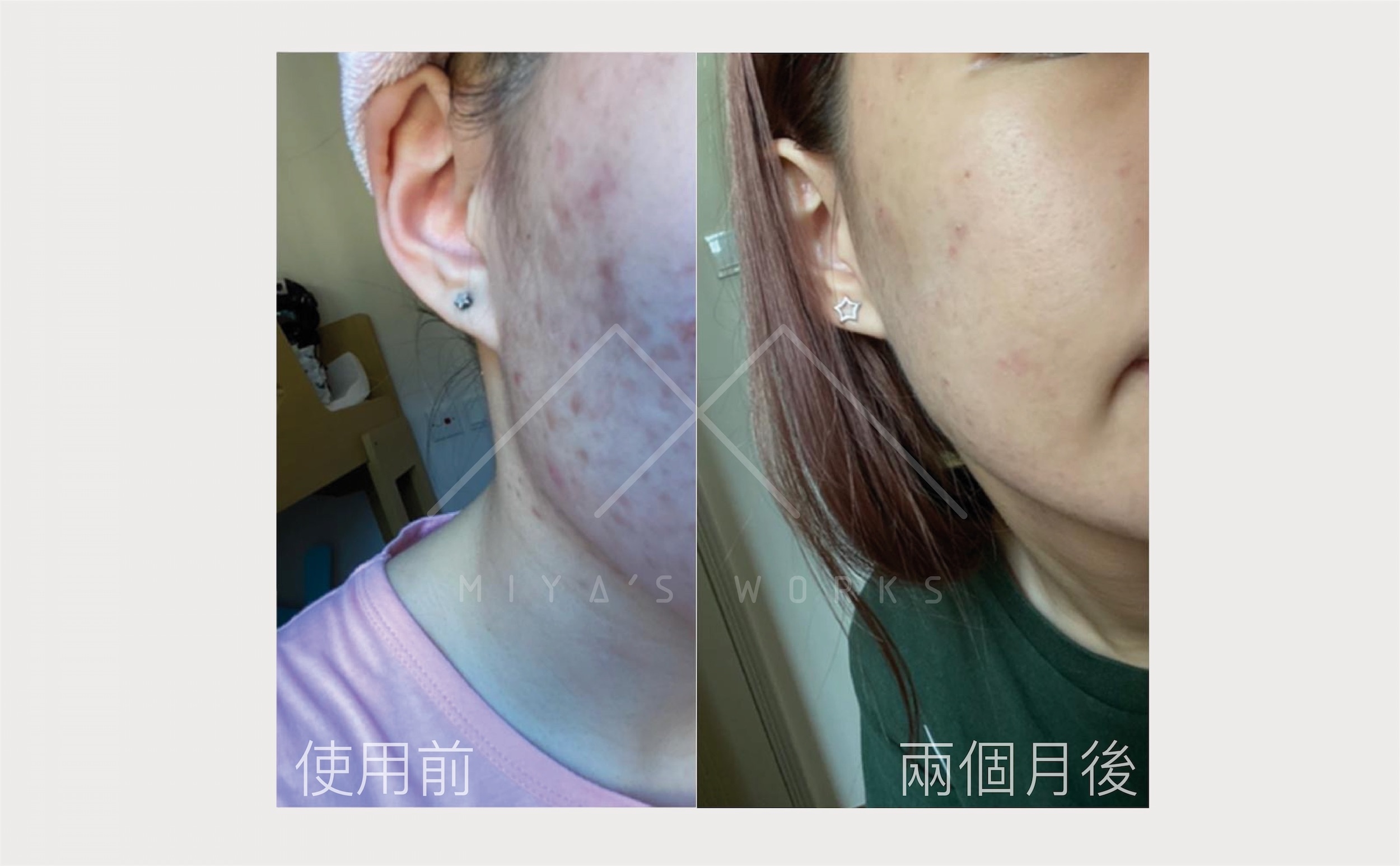 面部暗瘡問題改善前後圖