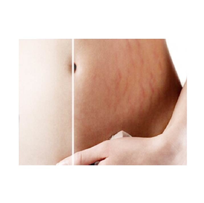 懷孕妊娠紋、肚紋