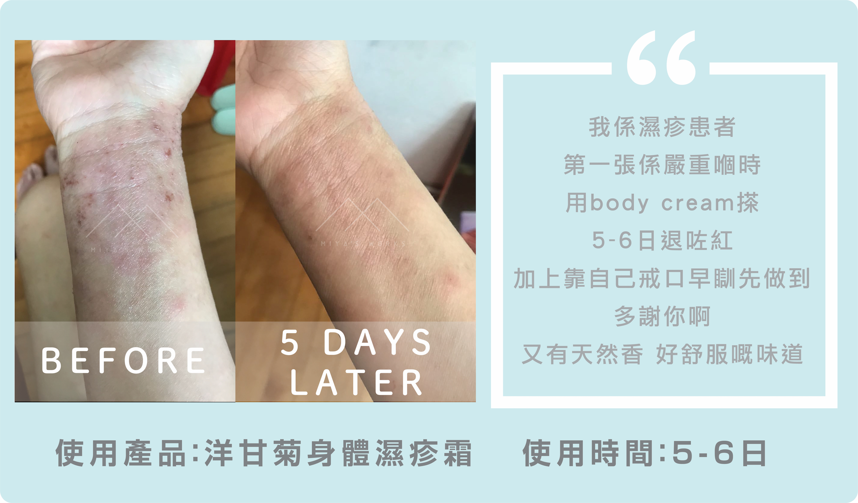 濕疹患者嚴重時使用洋甘菊身體濕疹霜成功退紅