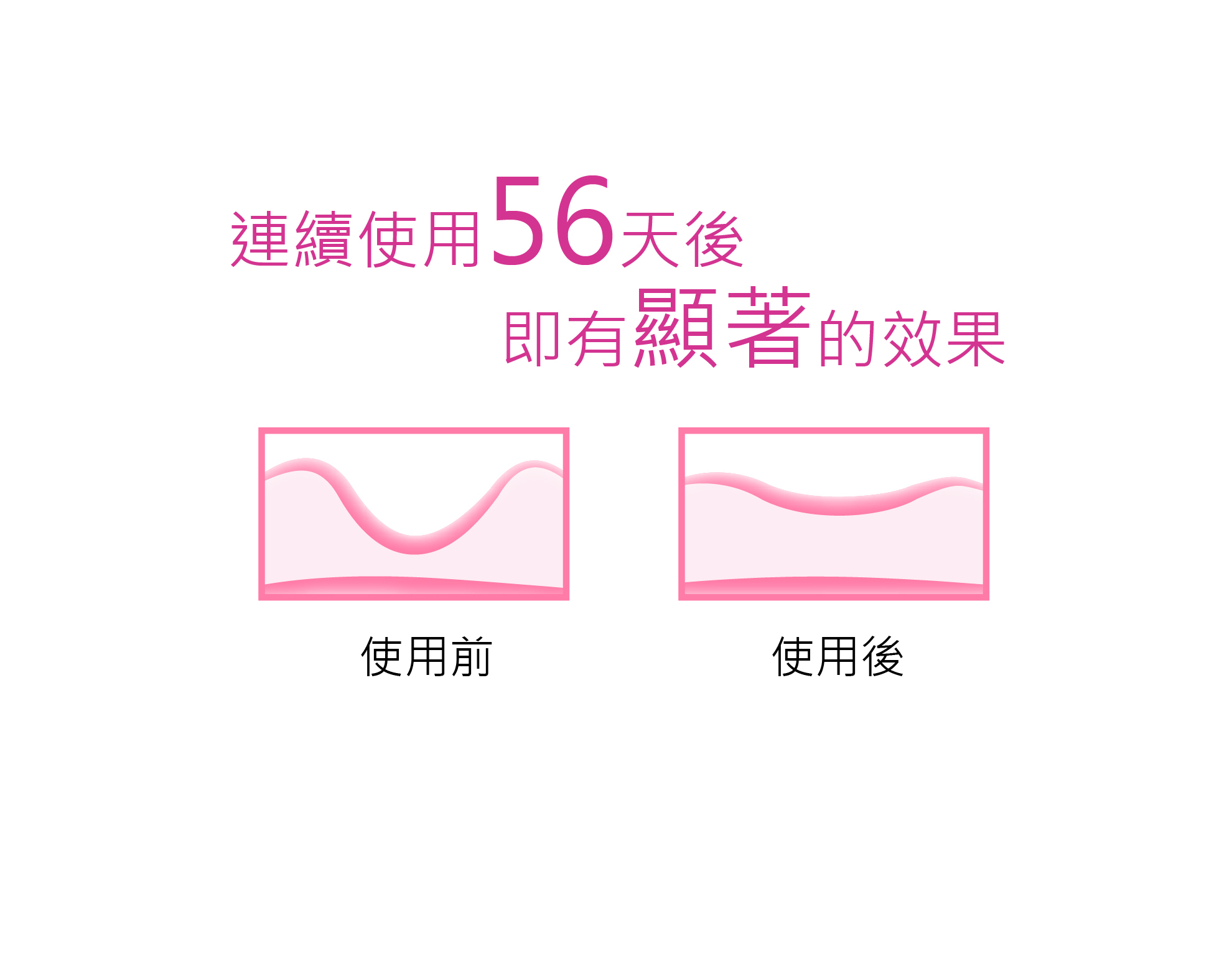 連續使用Maternea 防妊娠紋霜56天後即有顯著的效果,為妊娠紋膏推介品牌