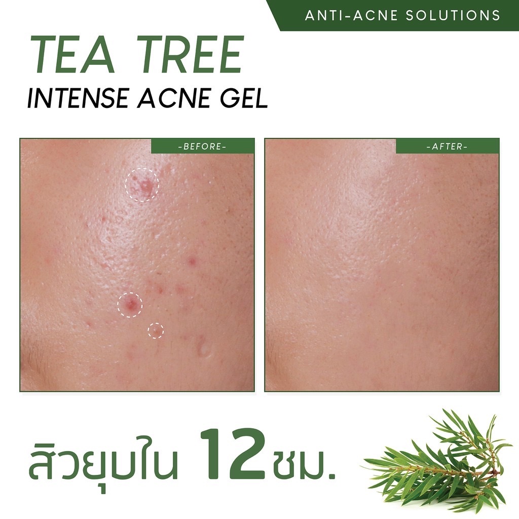 PLANTNERY 茶樹精油去暗瘡精華凝膠 15G