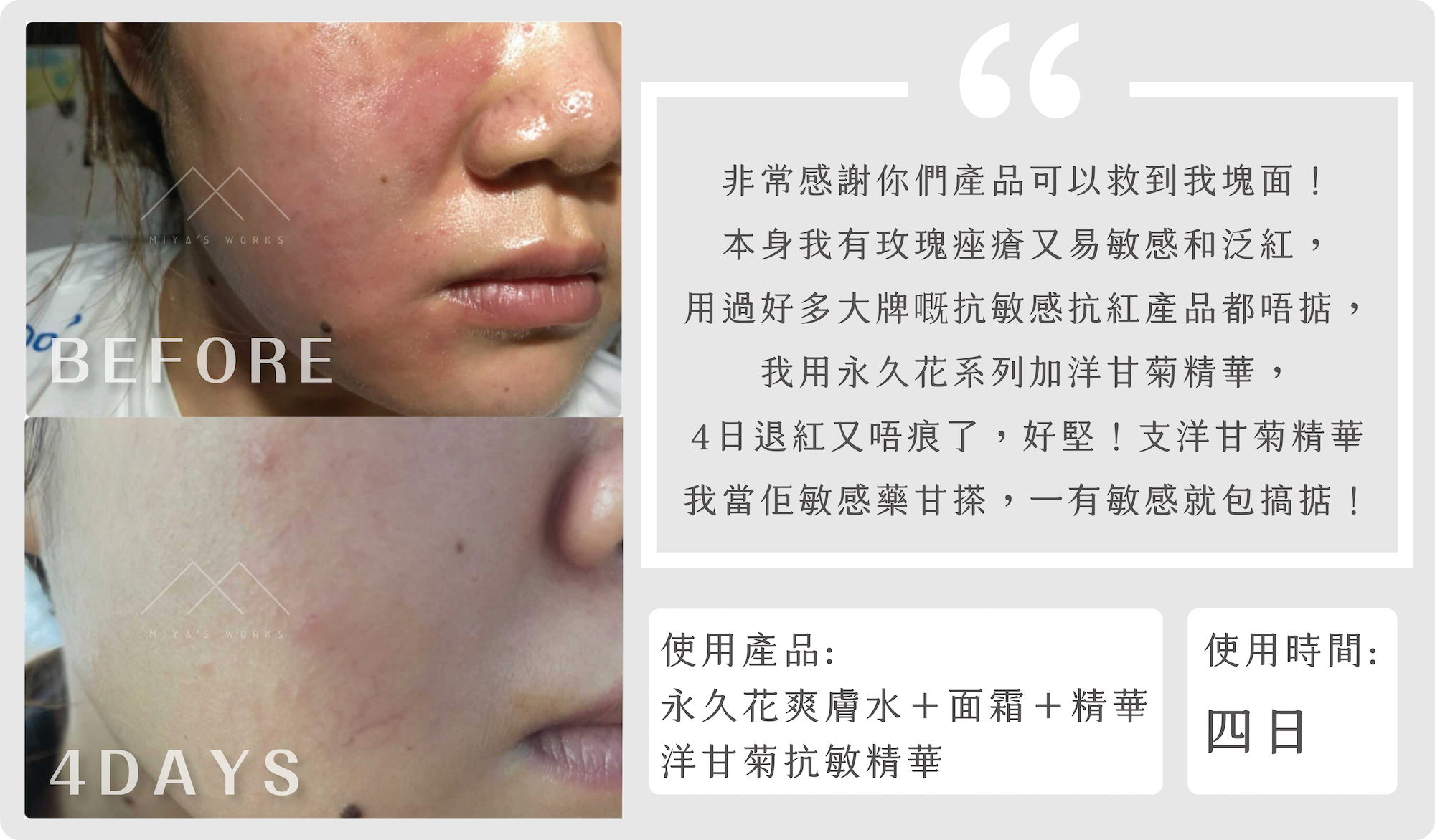有玫瑰痤瘡又易敏感泛紅使用永久花系列及洋甘菊精華極速退紅不再痕癢