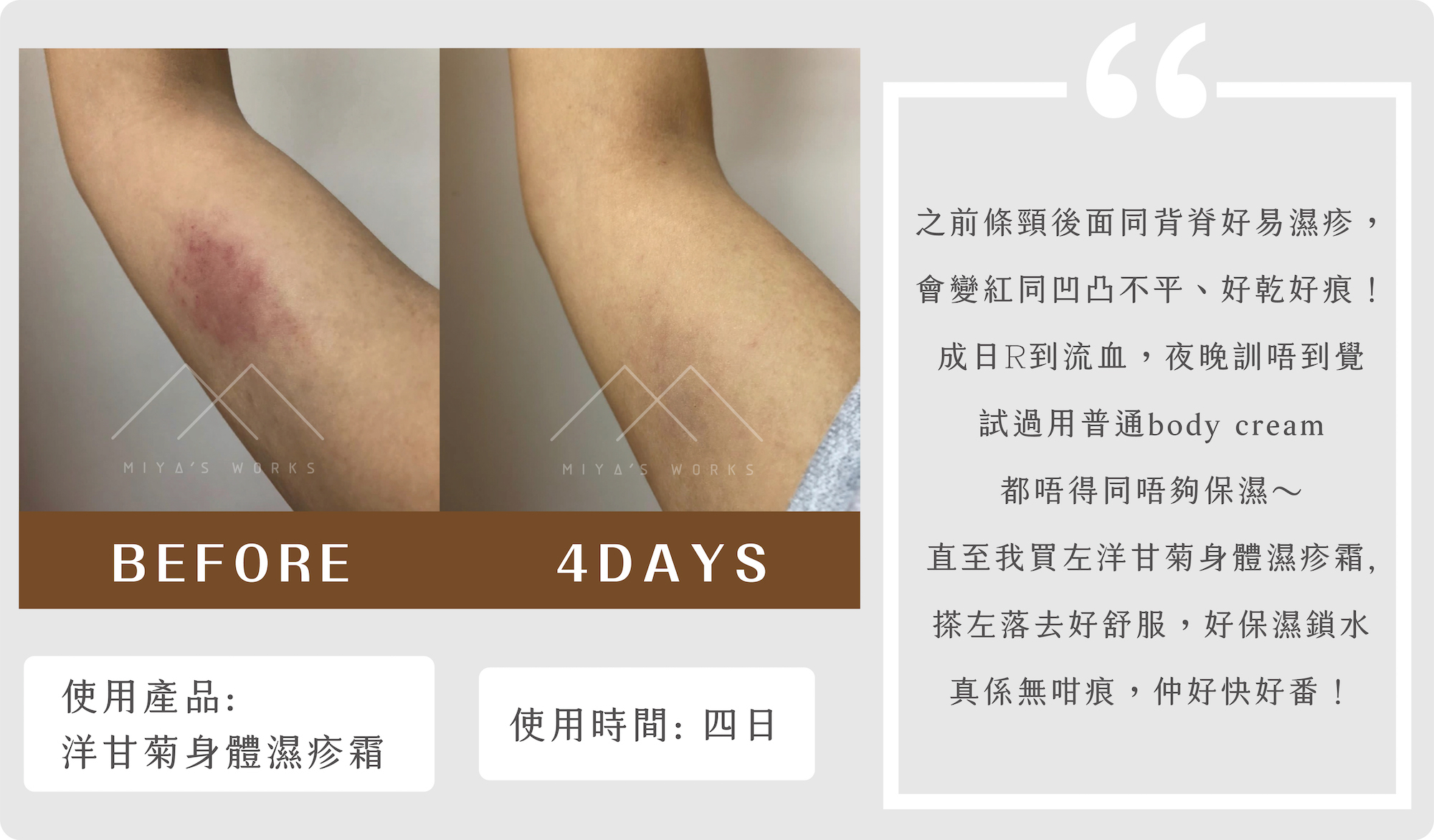 使用洋甘菊身體濕疹霜舒緩濕疹痕癢