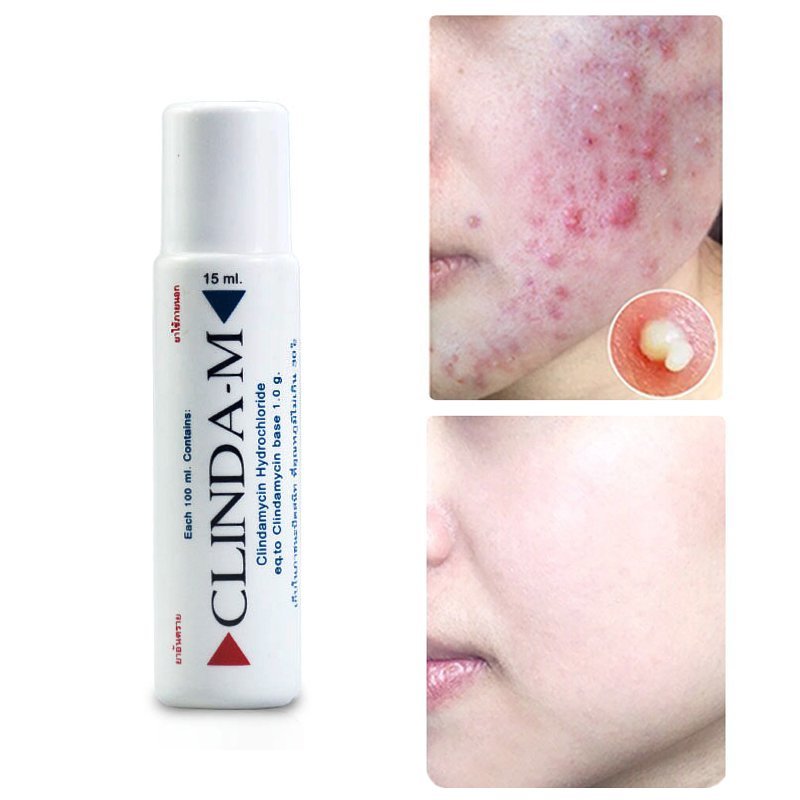 CLINDA-M暗瘡水 15ml