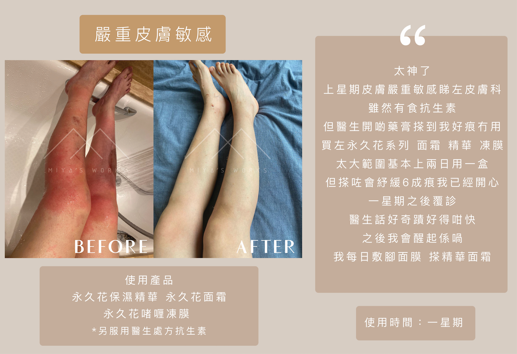 嚴重皮膚敏感使用永久花系列產品舒緩痕癢