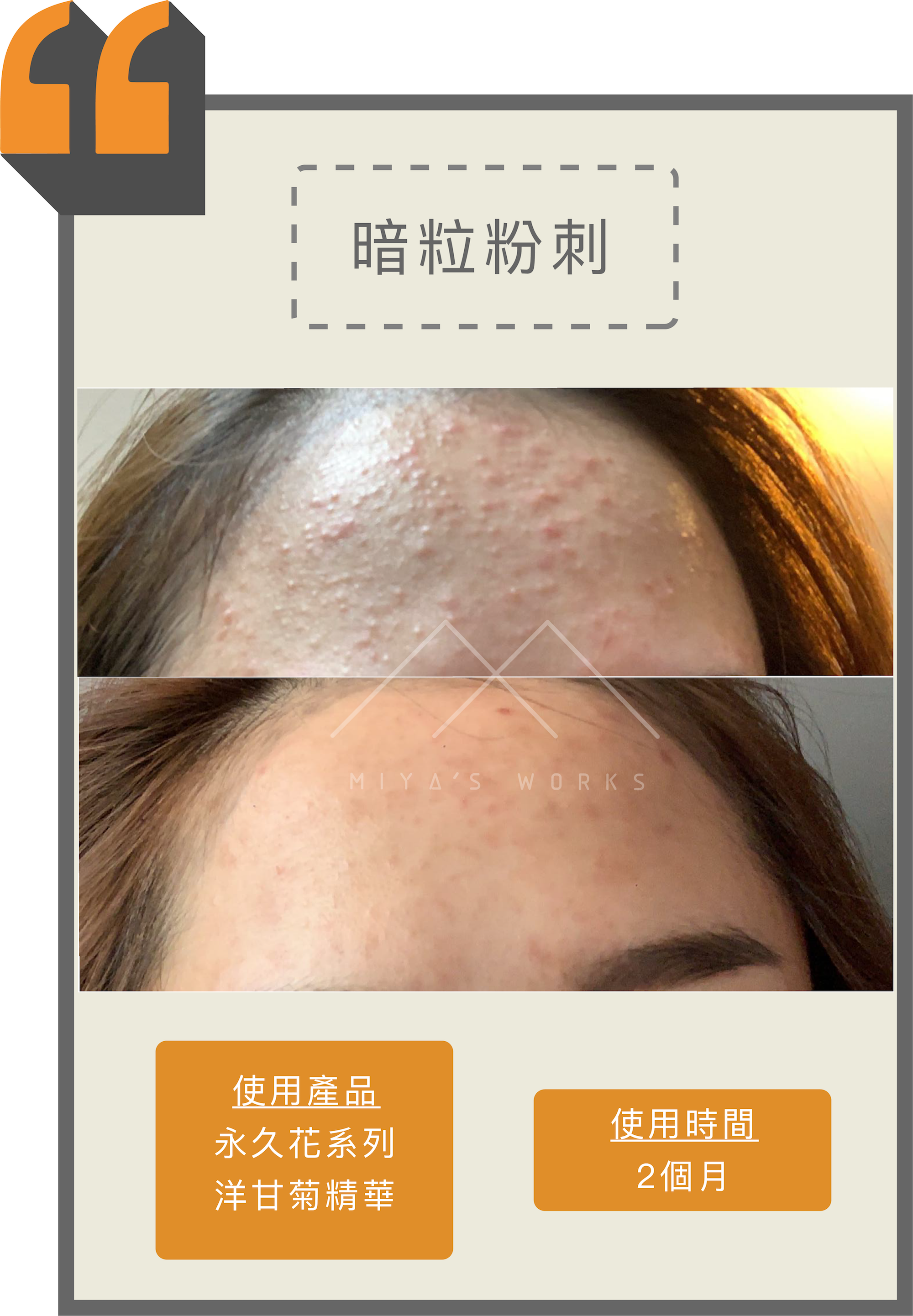 使用永久花系列及洋甘菊精華改善額頭暗粒粉刺