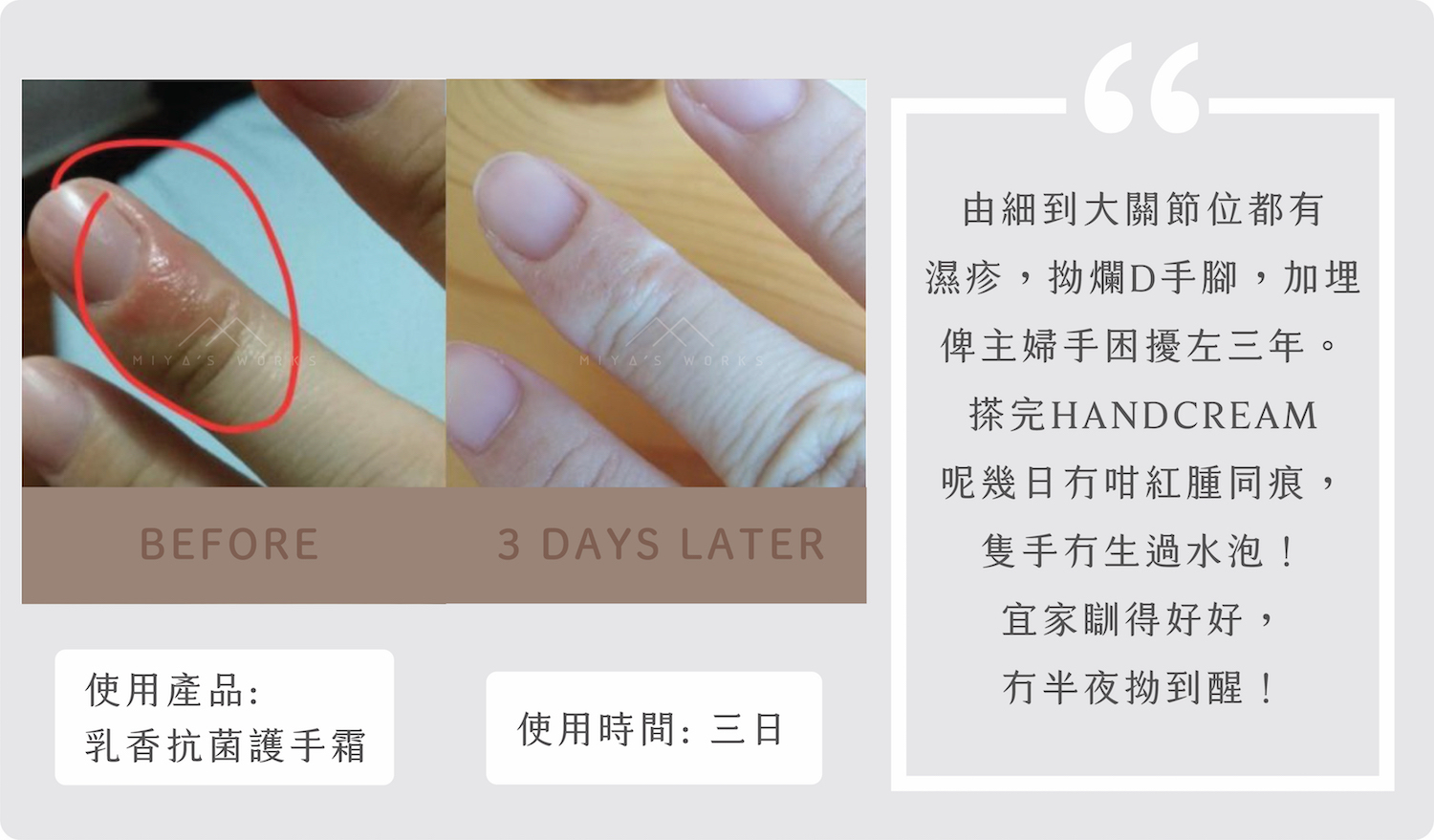 受濕疹及主婦手困擾三年使用手霜三日改善紅腫痕癢
