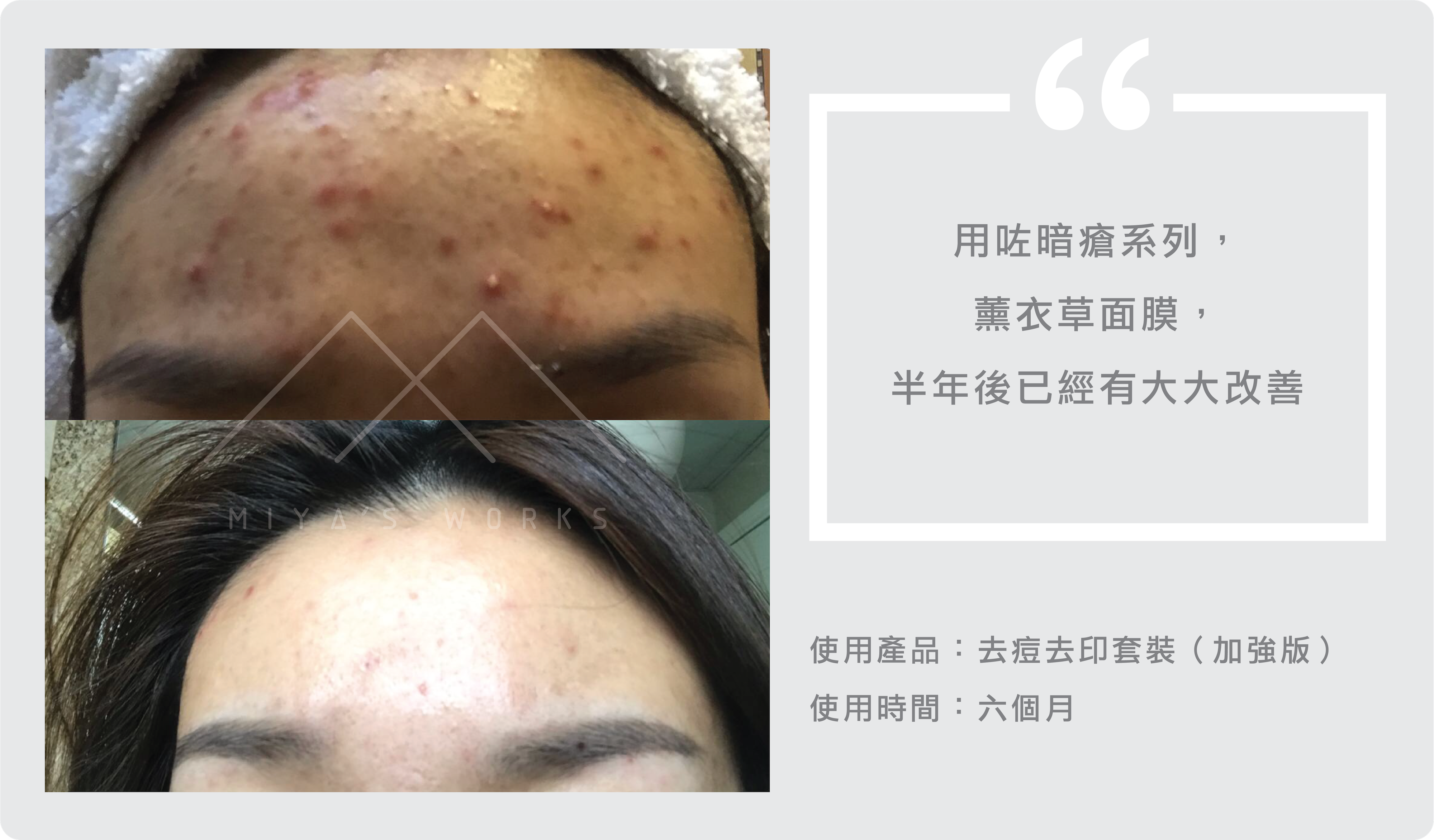 使用去痘去印套裝加強版成功改善暗瘡問題