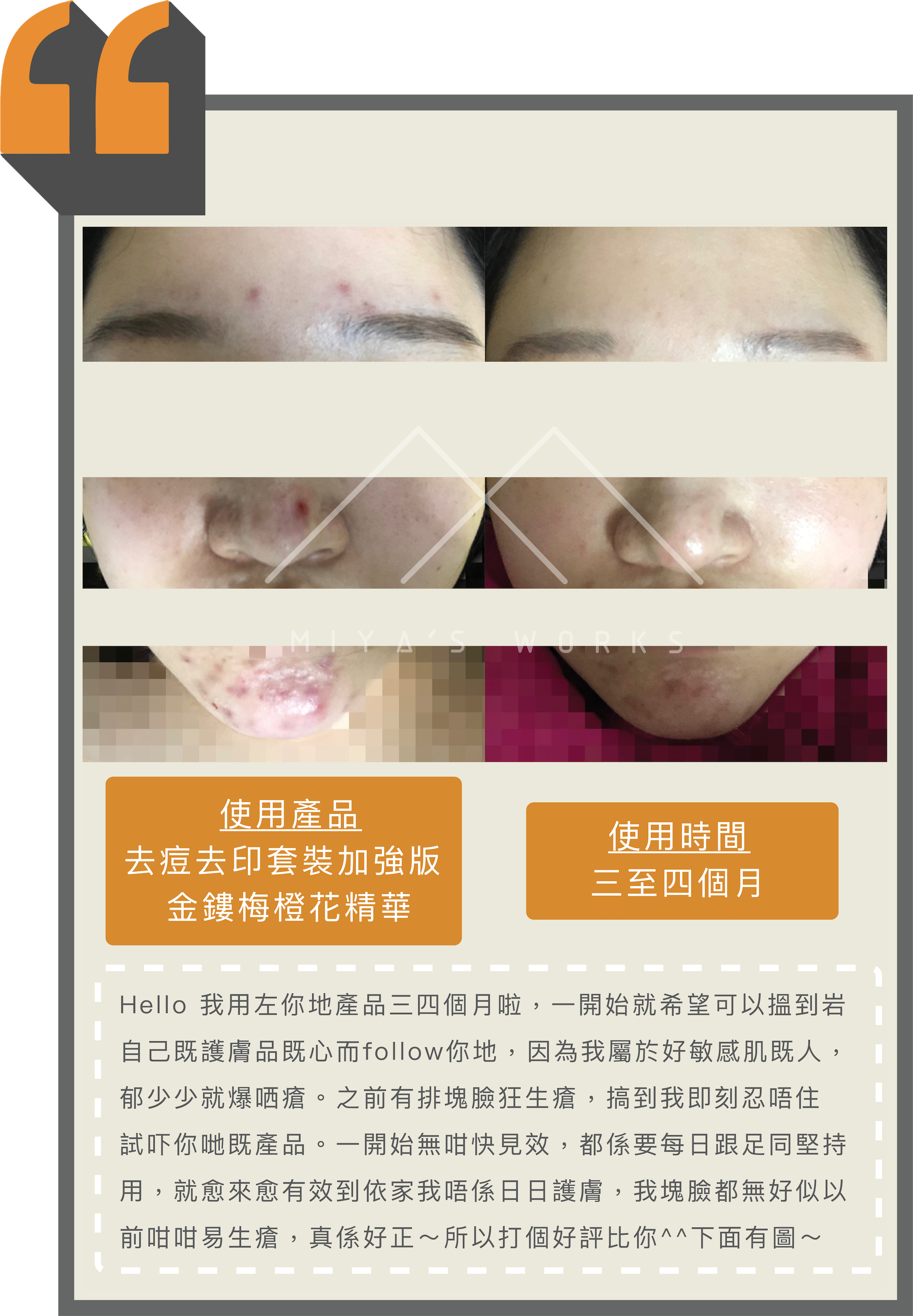 敏感肌使用去痘去印套裝加強版及金縷梅橙花精華成功改善皮膚少生瘡