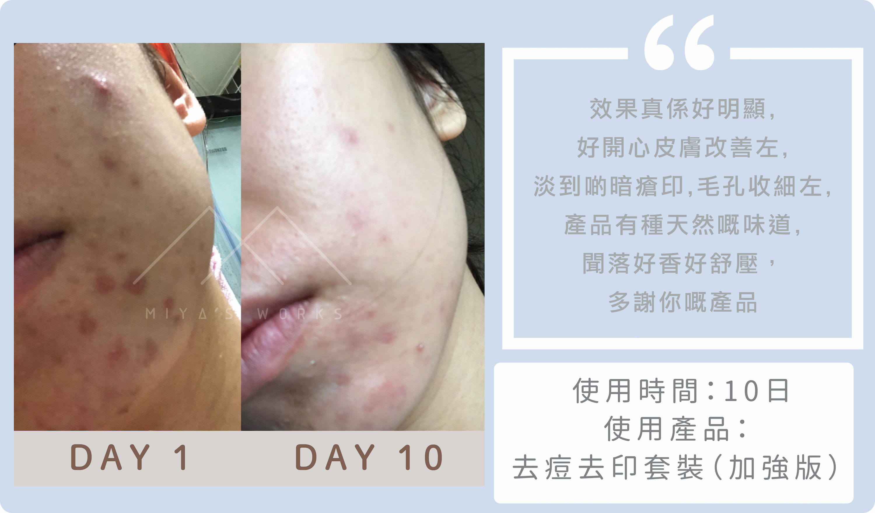 使用去痘去印套裝加強版淡暗瘡印收細毛孔