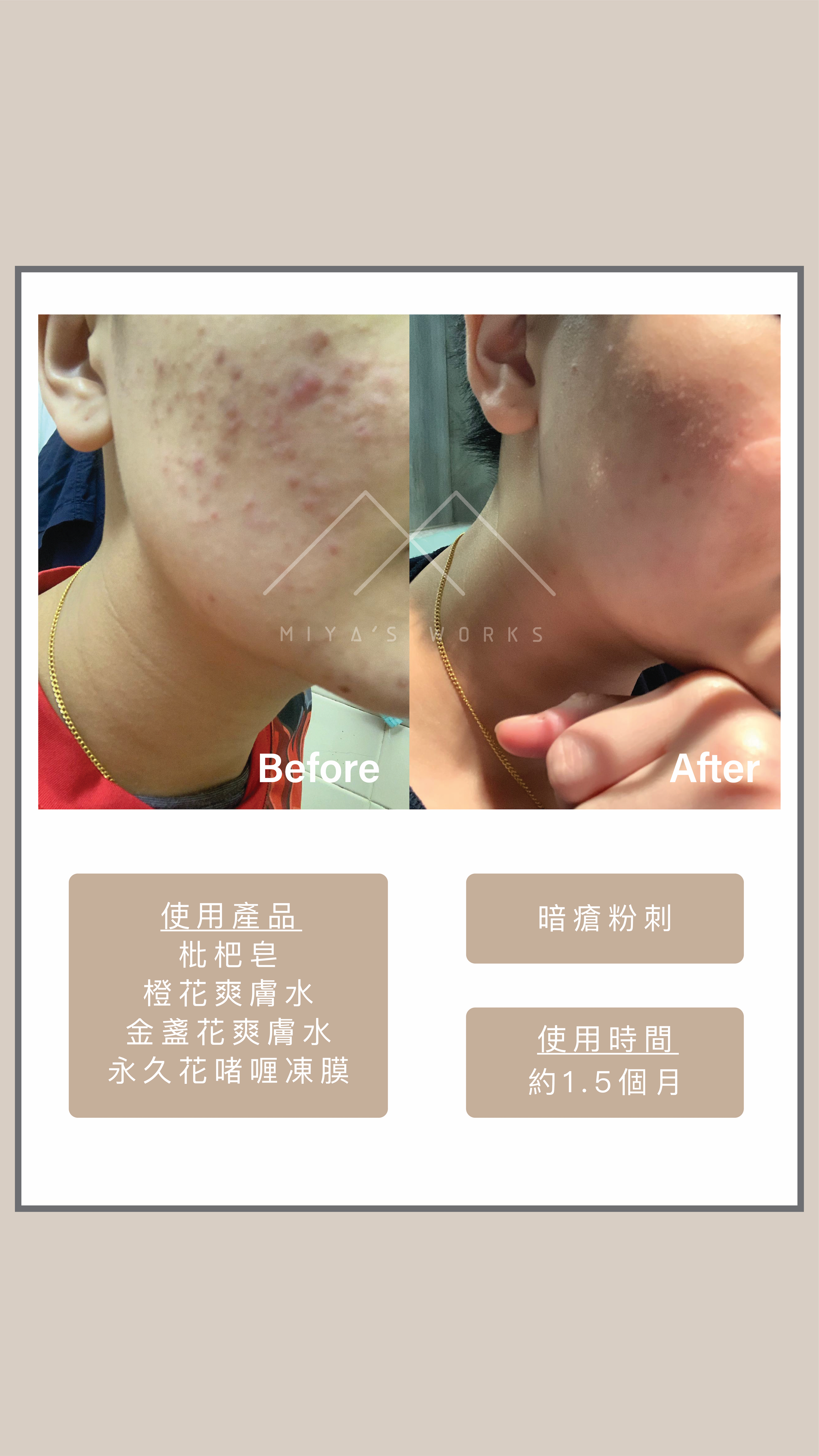 使用永久花凍膜消退暗瘡粉刺