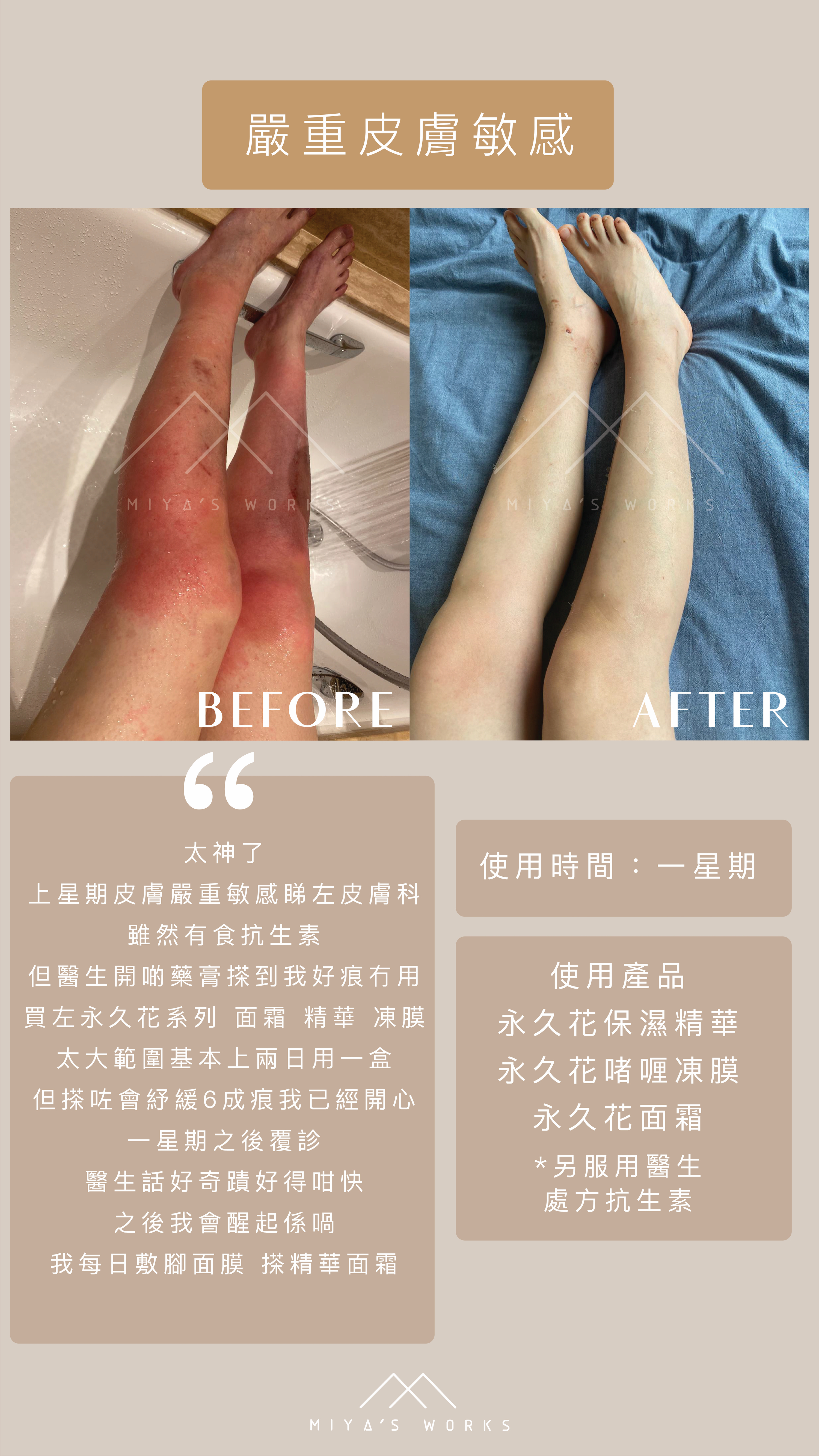 嚴重皮膚敏感使用永久花系列產品舒緩痕癢