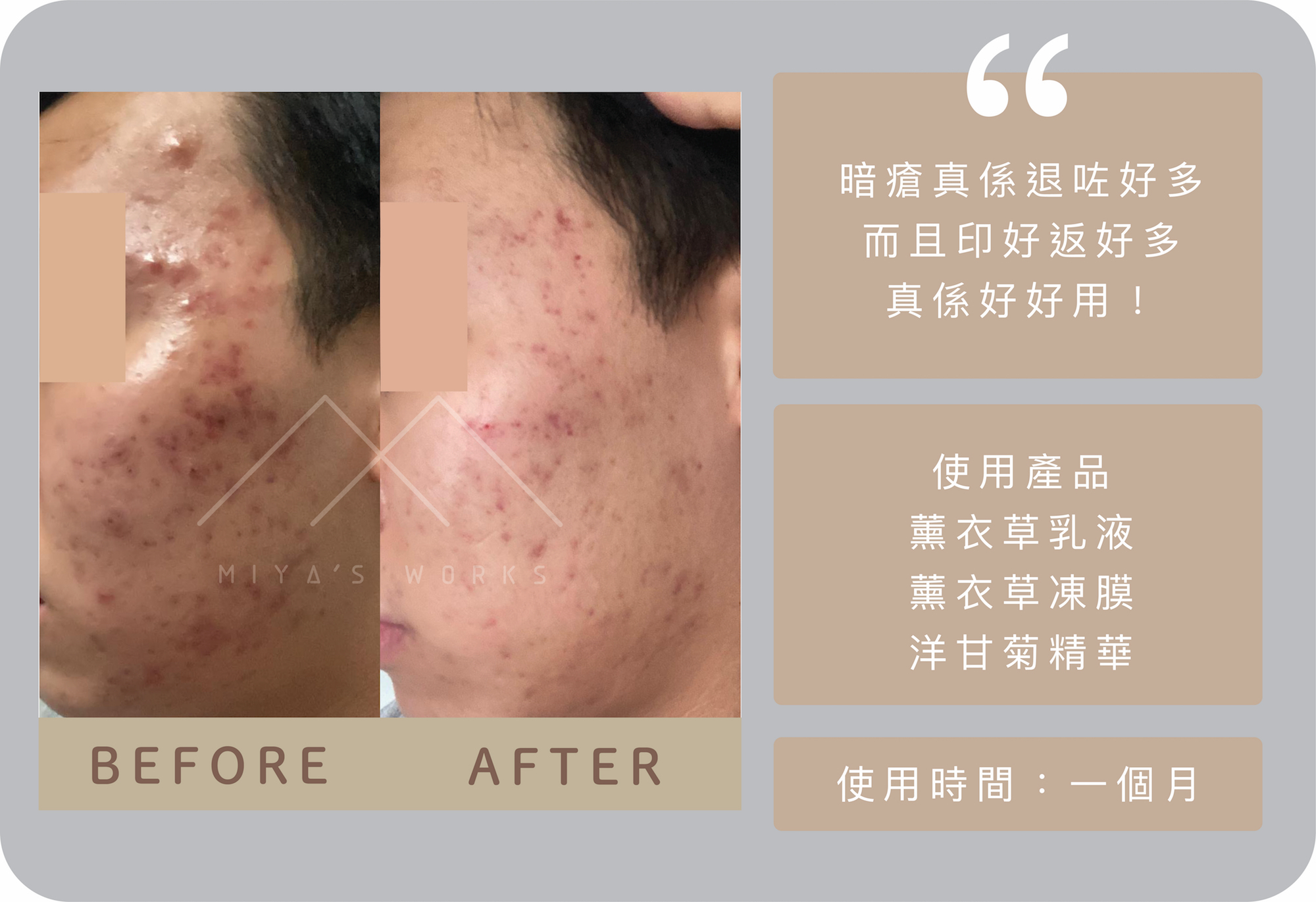使用薰衣草乳液薰衣草凍膜洋甘菊精華成功消退暗瘡淡化痘印