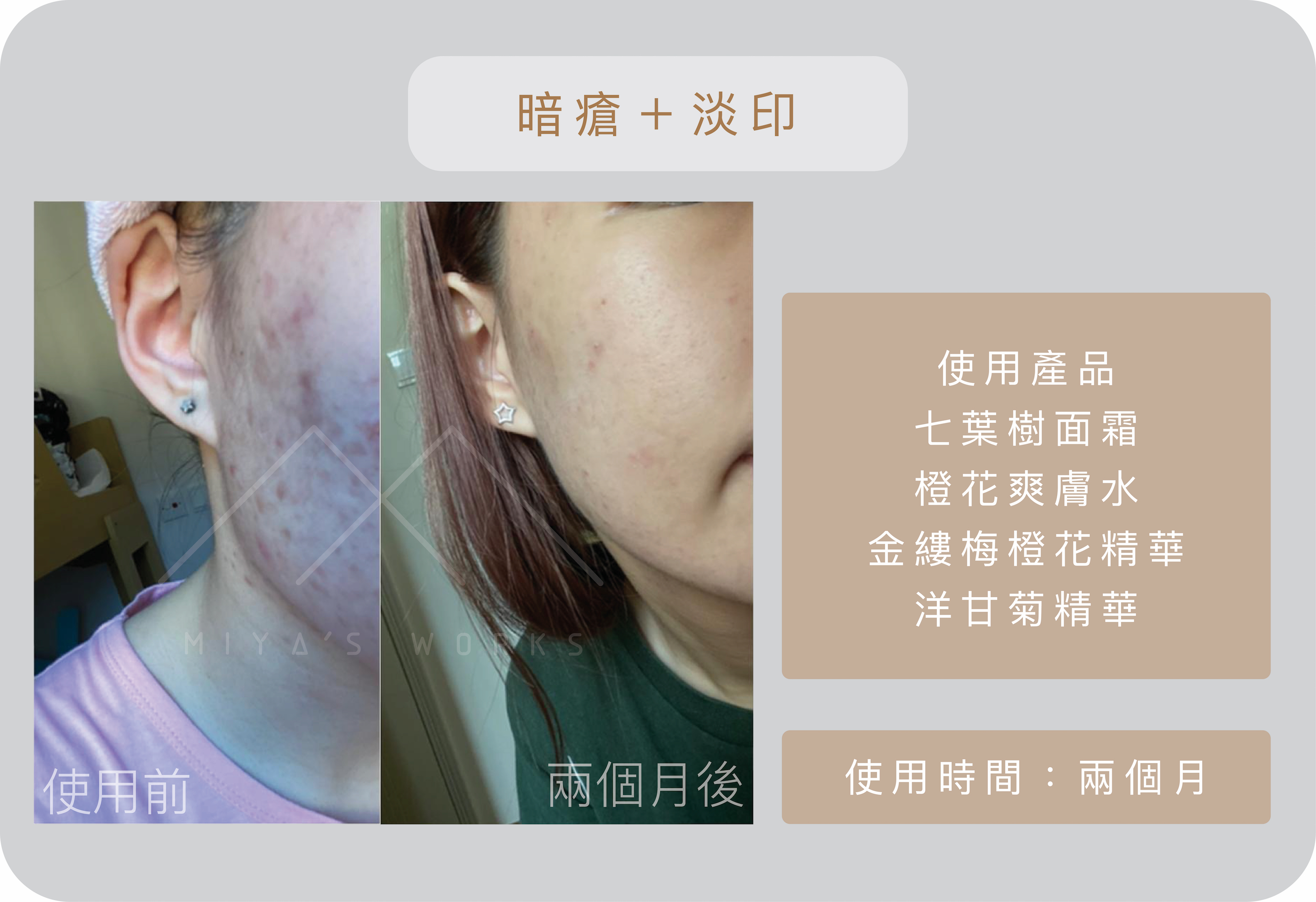 使用七葉樹面霜橙花爽膚水金縷梅橙花精華洋甘菊精華消退暗瘡淡印
