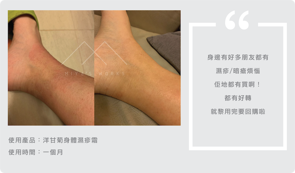 使用洋甘菊身體濕疹霜濕疹情況好轉